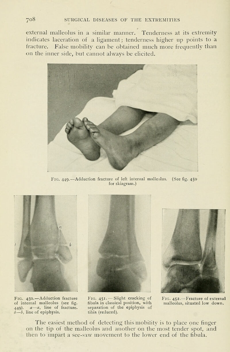 external malleolus in a similar manner. Tenderness at its extremity indicates laceration of a ligament; tenderness higher up points to a fracture. False mobility can be obtained much more frequently than on the inner side, but cannot always be elicited. Fig. 449. -Adduction fracture of left internal malleolus. (See fig. 450 for skiagram.) Fig. 450.—Adduction fracture of internal malleolus (see fig. 449). a—a, line of fracture. b—b, line of epiphysis. Fig. 451. — Slight cracking of Fig. 452.—Fracture of external fibula in classical position, with malleolus, situated low down, separation of the epiphysis of tibia (reduced). The easiest method of detecting this mobility is to place one finger on the tip of the malleolus and another on the most tender spot, and then to impart a see-saw movement to the lower end of the fibula.