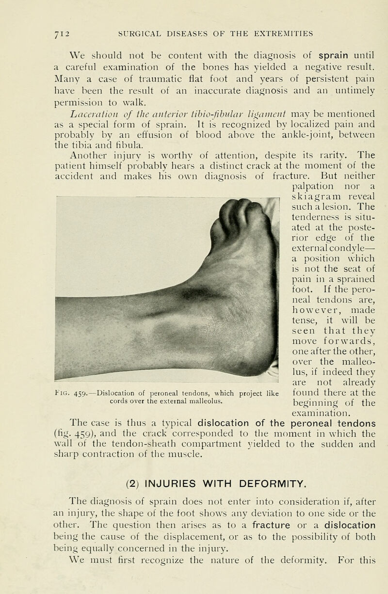 We should not be content with the diagnosis of sprain until a careful examination of the bones has yielded a negative result. Many a case of traumatic flat foot and years of persistent pain have been the result of an inaccurate diagnosis and an untimely permission to walk. Laceration of ilie anterior tibio-fibular ligament ma\' be mentioned as a special form of sprain. It is recognized by localized pain and probably by an effusion of blood above the ankle-joint, between the tibia and fibula. Another injury is worthy of attention, despite its rarity. The patient himself probably hears a distinct crack at the moment of the accident and makes his own diagnosis of fracture. But neither palpation nor a skiagram reveal such a lesion. The tenderness is situ- ated at the poste- rior edge of the external condyle— a position which is not the seat of pain in a sprained foot. If the pero- neal tendons are, however, made tense, it will be seen that they move forwards, one after the other, over the malleo- lus, if indeed they are not already found there at the beginning of the examination. The case is thus a typical dislocation of the peroneal tendons (fig. 459), and the crack corresponded to the moment in which the wall of the tendon-sheath compartment yielded to the sudden and sharp contraction of the muscle. Fig. 459.—Dislocation of peroneal tendons, which project like cords over the external malleolus. (2) INJURIES WITH DEFORMITY. The diagnosis of sprain does not enter into consideration if, after an injury, the shape of the foot shows any deviation to one side or the other. The question then arises as to a fracture or a dislocation being the cause of the displacement, or as to the possibility of both being equally concerned in the injury. We must first recognize the nature of the deformity. For this