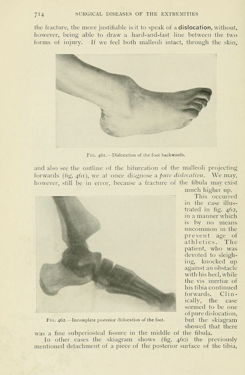 the fracture, the more justifiable is it to speak of a dislocation, without, however, being able to draw a hard-and-fast line between the two forms of injury. If we feel both malleoli intact, through the skin^ Fig. 461.—Dislocation of the foot backwards. and also see the outline of the bifurcation of the malleoli projecting forwards (fig. 461), we at once diagnose 2. pure dislocation. We may, liowever, still be in error, because a fracture of the fibula may exist much higher up. This occurred in the case illus- trated in fig. 462, in a manner which is by no means uncommon in the present age of athletics. The patient, who was devoted to sleigh- ing, knocked up against an obstacle with his heel, while the vis inertiae of his tibia continued forwards. Clin- ically, the case seemed to be one of pure dislocation, Fig. 462.—Incomplete posterior dislocation of the foot. but the skiagram showed that there was a fine subperiosteal fissure in the middle of the fibula. In other cases the skiagram shows (fig. 460) the previously mentioned detachment of a piece of the posterior surface of the tibia,