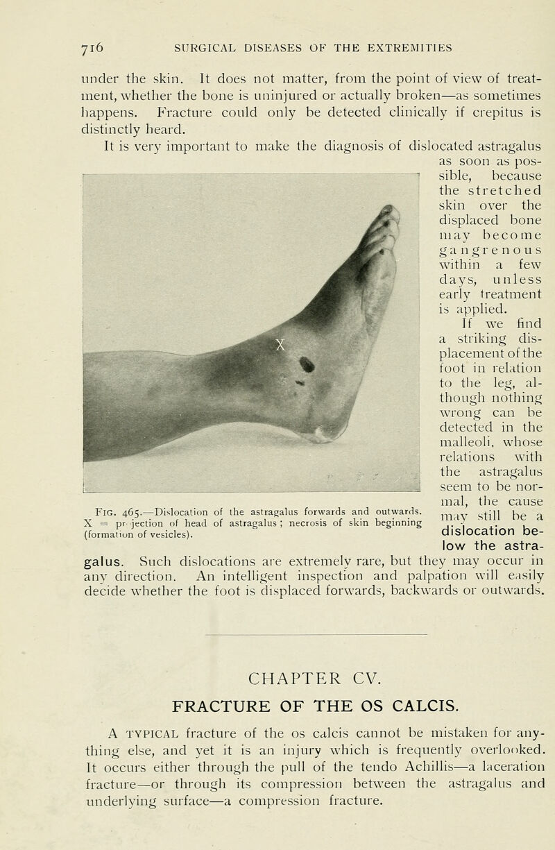 under the skin. It does not matter, from the point of view of treat- ment, whether the bone is uninjured or actually broken—as sometimes happens. Fracture could only be detected clinically if crepitus is distinctly heard. It is very important to make the diagnosis of dislocated astragalus as soon as pos- sible, because the stretched skin over the displaced bone may become gangrenous within a few days, unless early treatment is applied. If we find a striking dis- placement of the foot in relation to tlie leg, al- though nothing wrong can be detected in the malleoli, whose relations with the astragalus seem to be nor- mal, the cause mav still be a dislocation be- low the astra- galus. Such dislocations are extremely rare, but they may occur in any direction. An intelligent inspection and palpation will easily decide whether the foot is displaced forwards, backwards or outwards. Fig. 465.—Dislocation of the astragalus forwards and outwards. X = pr jection of head of astragalus; necrosis of skin beginning (formation of vesicles). CHAPTER CV. FRACTURE OF THE OS CALCIS. A TYPICAL fracture of the os calcis cannot be mistaken for any- thing else, and yet it is an injury which is frequently overlooked. It occurs either through the pull of the tendo Achillis—a laceration fracture—or through its compression between the astragalus and underlying surface—a compression fracture.