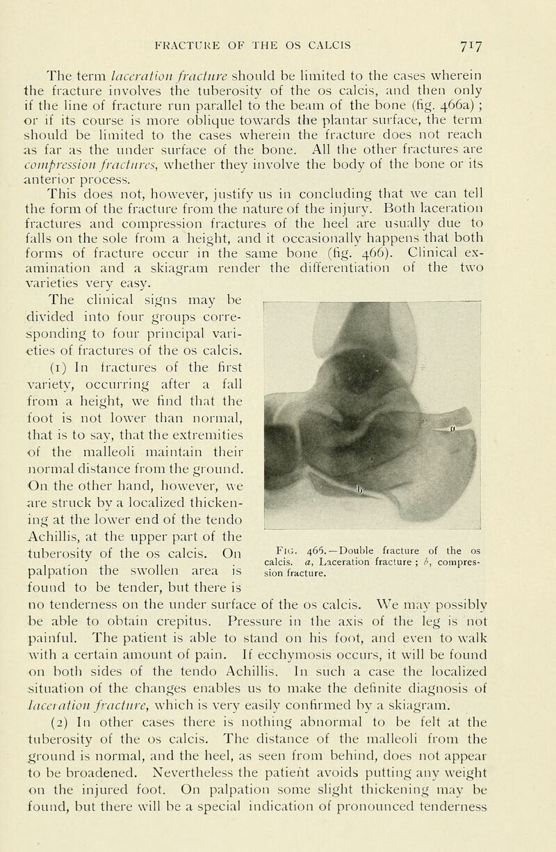 The term laceration fracture should be Hmited to the cases wherein the fracture involves the tuberosity of the os calcis, and then only if the line of fracture run parallel to the beam of the bone (fig. 466a) ; or if its course is more oblique towards the plantar surface, the term should be limited to the cases wherein the fracture does not reach as far as the under surface of the bone. All the other fractures are compression fractures, whether they involve the body of the bone or its anterior process. This does not, however, justify us in concluding that we can tell the form of the fracture from the nature of the injury. Both laceration fractures and compression fractures of the heel are usually due to falls on the sole from a height, and it occasionally happens that both forms of fracture occur in the same bone (fig. 466). Clinical ex- amination and a skiagram render the differentiation of the two varieties very easy. The clinical signs may be divided into four groups corre- sponding to four principal vari- eties of fractures of the os calcis. (i) In fractures of the first variety, occurring after a fall from a height, we find that the foot is not lower than normal, that is to say, that the extremities of the malleoli maintain their normal distance from the ground. On the other hand, however, we are struck by a localized thicken- ing at the lower end of the tendo Achillis, at the upper part of the tuberosity of the os calcis. On palpation the swollen area is found to be tender, but there is no tenderness on the under surface of the os calcis. We may possibly be able to obtain crepitus. Pressure in the axis of the leg is not painful. The patient is able to stand on his foot, and even to walk with a certain amount of pain. If ecchymosis occurs, it will be found on both sides of the tendo Achillis. In such a case the localized situation of the changes enables us to make the definite diagnosis of laceration fracture, which is very easily confirmed by a skiagram. (2) In other cases there is nothing abnormal to be felt at the tuberosity of the os calcis. The distance of the malleoli from the ground is normal, and the heel, as seen from behind, does not appear to be broadened. Nevertheless the patient avoids putting any weight on the injured foot. On palpation some slight thickening may be found, but there will be a special indication of pronounced tenderness Fig. 466.—Double fracture of the os calcis. a, Laceration fracture ; /■>, compres- sion fracture.