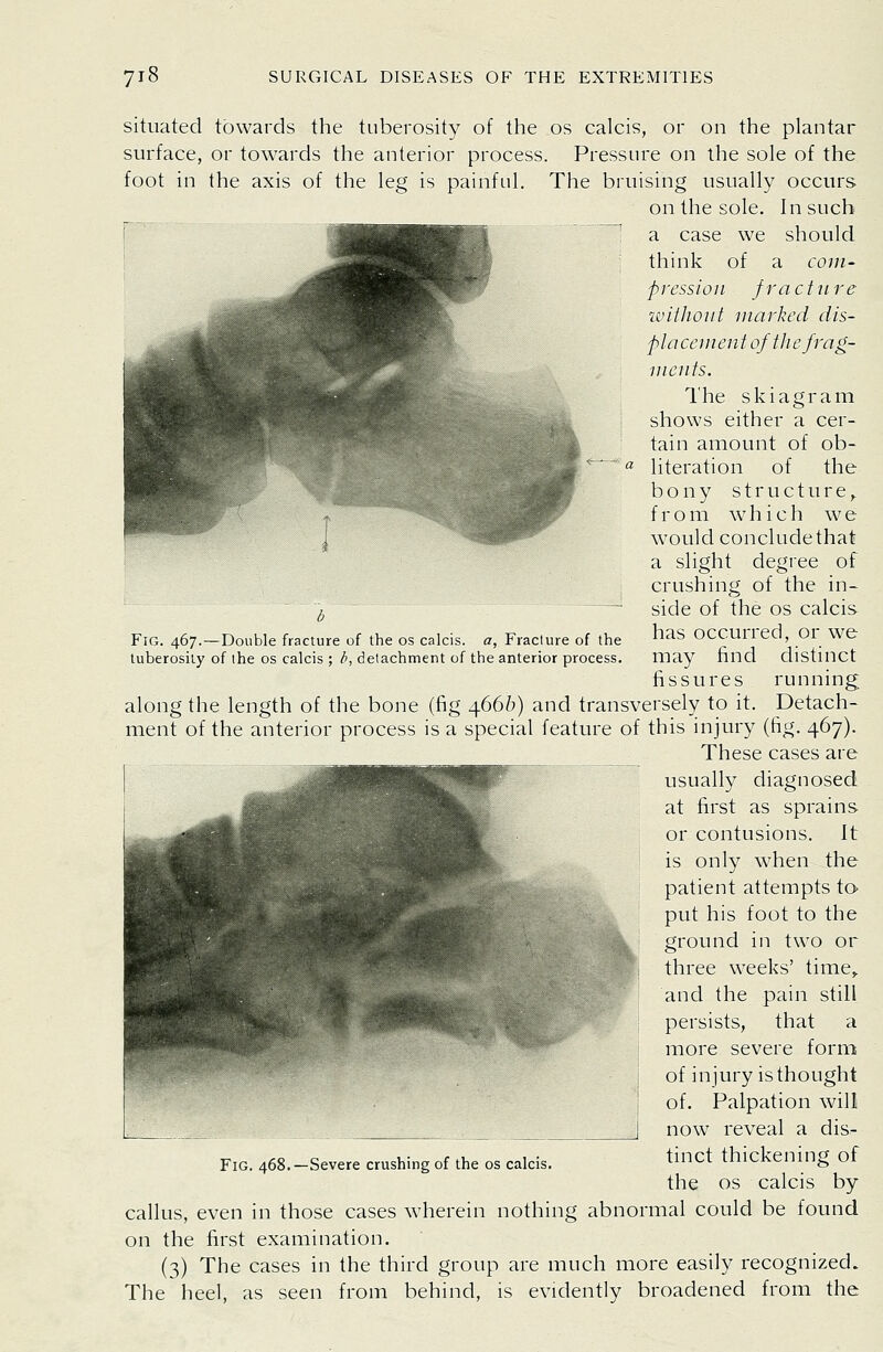 Fig. 467.—Double fracture of the os calcis. a, Fracture of the tuberosity of the os calcis ; b, detachment of the anterior process. situated towards the tuberosity of the os calcis, or on the plantar surface, or towards the anterior process. Pressure on the sole of the foot in the axis of the leg is painful. The bruising usually occurs on the sole. In such a case we should think of a com- pression fracture iviiJiont marked dis- placenient of tlie frag- ments. I'he skiagram shows either a cer- tain amount of ob- literation of the bony structure,, from which we would conclude that a slight degree of crushing of the in- side of the OS calcis has occurred, or we may find distinct fissures running along the length of the bone (fig 4666) and transversely to it. Detach- ment of the anterior process is a special feature of this injury (fig. 467). These cases are usually diagnosed at first as sprains or contusions. It is only when the patient attempts to- put his foot to the ground in two or three weeks' time,, and the pain still persists, that a more severe form of injury is thought of. Palpation will now reveal a dis- tinct thickening of the OS calcis by callus, even in those cases wherein nothing abnormal could be found on the first examination. (3) The cases in the third group are much more easily recognized. The heel, as seen from behind, is evidently broadened from the Fig. 468.—Severe crushing of the os calcis.