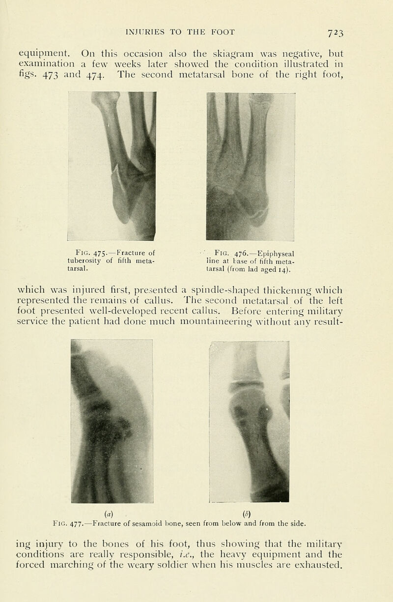 equipment. On this occasion also the skiagram was negative, but examination a few weeks later showed the condition illustrated in figs, 473 and 474. The second metatarsal bone of the right foot, Fig. 475.—Fracture of tuberosity of fifth meta- tarsal. ' _ Fig. 476.—Epiphyseal line at base of fifth meta- tarsal (from lad aged 14). which was injured first, presented a spindle-shaped thickenmg which represented the remains of callus. The second metatarsal of the left foot presented well-developed recent callus. Before entering military service the patient had done much mountaineering without any result- ed) (^) Fig. 477.—Fracture of sesamoid l)one, seen from below and from the side. ing injury to the bones of his foot, thus sliowing that the military conditions are really responsible, i.e., the heavy equipment and the forced marching of the weary soldier when his muscles aie exhausted.