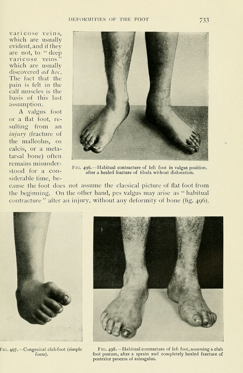 varicose veins, which are usually evident, and if they are not, to  deep varicose veins  which are usually discovered ad hoc. The fact that the pain is felt in the calf muscles is the basis of this last assumption. A valgus foot or a flat foot, re- sulting from an injury (fracture of the malleolus, os calcis, or a meta- tarsal bone) often remains misunder- stood for a con- siderable time, be- cause the foot does not assume the classical picture of flat foot from the beginning. On the other hand, pes valgus may arise as  habitual contracture  after an injury, without any deformity of bone (fig. 496). Fig. 496.—Habitual contracture of left foot in valgus position, after a healed fracture of fibula without dislocation. Fig. 497.—Congenital clubfoot (simple form). Fig. 498.—Habitual contracture of left foot, assuming a club foot posture, after a sprain and completely healed fracture of posterior process of astragalus.