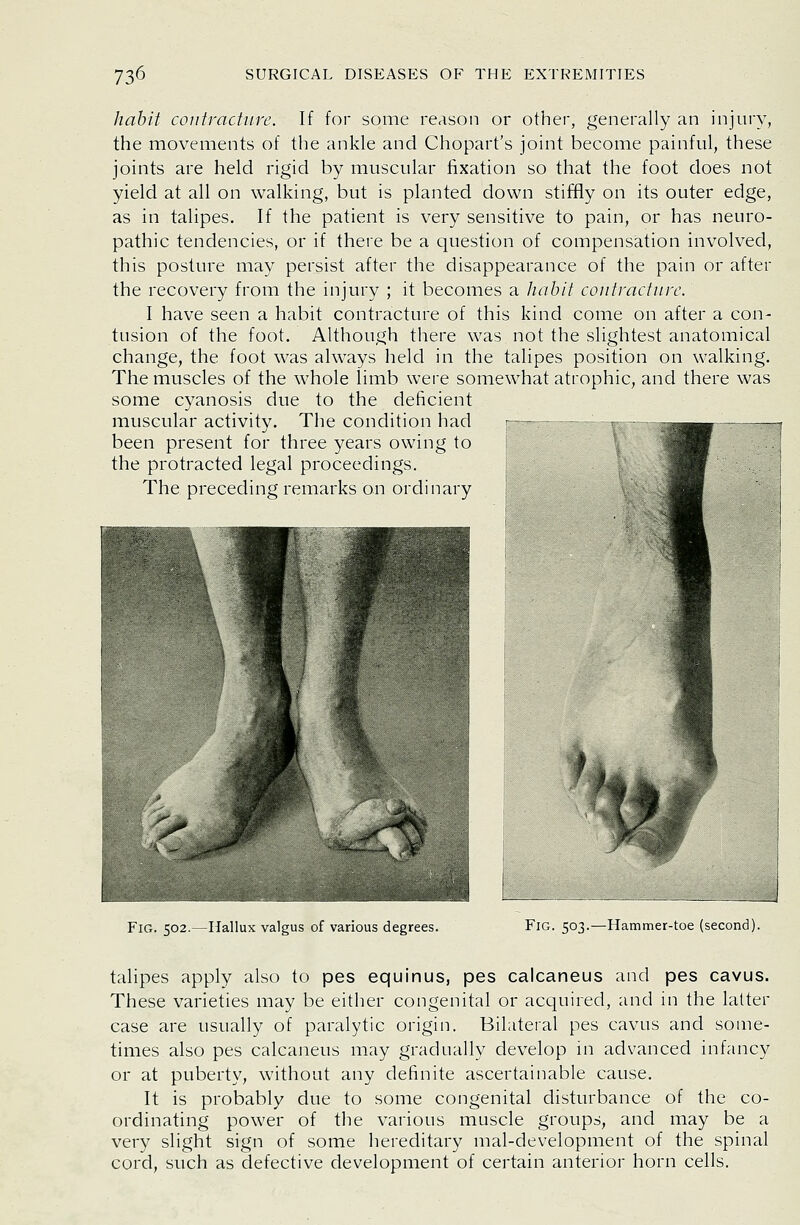 hahit contracture. If for some reason or other, generally an injury, the movements of the ankle and Chopart's joint become painful, these joints are held rigid by muscular fixation so that the foot does not yield at all on walking, but is planted down stiffly on its outer edge, as in talipes. If the patient is very sensitive to pain, or has neuro- pathic tendencies, or if there be a question of compensation involved, this posture may persist after the disappearance of the pain or after the recovery from the injury ; it becomes a habit contracture. I have seen a habit contracture of this kind come on after a con- tusion of the foot. Although there was not the slightest anatomical change, the foot was always held in the talipes position on walking. The muscles of the whole limb were somewhat atrophic, and there was some cyanosis due to the deficient muscular activity. The condition had been present for three years owing to the protracted legal proceedings. The preceding remarks on ordinary Fig. 502.—Hallux valgus of various degrees. Fig. 503.—Hammer-toe (second). talipes apply also to pes equinus, pes calcaneus and pes cavus. These varieties may be either congenital or acquired, and in the latter case are usually of paralytic origin. Bilateral pes cavus and some- times also pes calcaneus may gradually develop in advanced infancy or at puberty, without any definite ascertainable cause. It is probably due to some congenital disturbance of the co- ordinating power of the various muscle groups, and may be a very slight sign of some hereditary mal-development of the spinal cord, such as defective development of certain anterior horn cells.