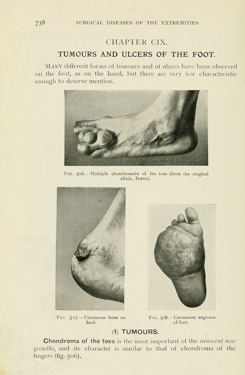 CHAPTER CIX. TUMOURS AND ULCERS OF THE FOOT. AlAXY different forms of tumours and of ulcers have been observed on the foot, as on the hand, but there are very few characteristic enough to deserve mention. Fig. 506.—Multiple chondromata of the toes (from the surgical clinic, Berne). Fig. 507.— Cutaneous horn on heel. Fig. 508.—Cavernous angioma of foot. (1) TUMOURS. Chondroma of the toes is the most important of the innocent new groivilis, and its character is similar to that of chondroma of the fingers (fig. 506).