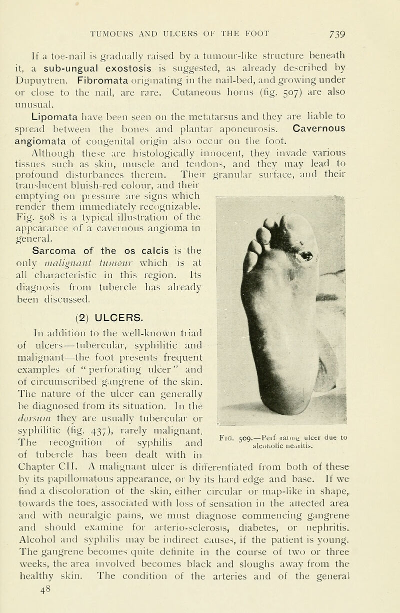 If a toe-nail is gradLially raised by a tLunoiii-like structure beneath it, a sub-ungual exostosis is suggested, as already described by Dupuytren. Fibromata originating in the nail-bed, and growing under or close to the nail, are rare. Cutaneous horns (fig. 507) are also unusual. Lipomata have been seen on the metatarsus and they are liable to spread between the bones and plantai- aponeurosis. Cavernous angiomata of congenital origin also occur on the foot. Although these are histologically innocent, they invade various tissufs such as skin, muscle and tendons, and the}' may lead to profound disturbances therem. Their granular surface, and their translucent bluish-red colour, and their emptying on piessure are signs which render them immediately recognizable. Fig. 508 is a tvpical illustration of the appearance of a cavernous angioma in general. Sarcoma of the os caicis is the only mallgnani iuiuour which is at all characteristic in this region. Its diagnosis from tubercle has already been discussed. (2) ULCERS. In addition to the well-known tiiad of ulcers — tubercular, syphilitic and malignant—the foot presents frequent examples of perforating ulcer and of circumscribed gangiene of the skin. The nature of the ulcer can generally be diagnosed from its situation. In the dorsum they are usually tubercular or syphilitic (fig. 437), rarely lualignant. The recognition of syfthilis and of tubercle has been dealt with in Chapter CII. A malignant ulcer is ditferentiated from both of these by its papillomatous appearance, or by its hard edge and base. If we find a discoloration of the skin, either circular or map-hke in shape,, towards the toes, associated with loss of sensation in the ailected area and with neuralgic pains, we must diagnose commencing gangrene and should examine for arterio-sclerosis, diabetes, or nephritis. Alcohol and syphilis may be indirect causes, if the patient is young. The gangrene becomes quite definite in the course of two or three weeks, the area involved becomes black and sloughs away from the healthy skin. The condition of the arteries and of the general 48 Fig. 509.—Fcif raim^ ulcer due to alcoholic neuiiii.s.