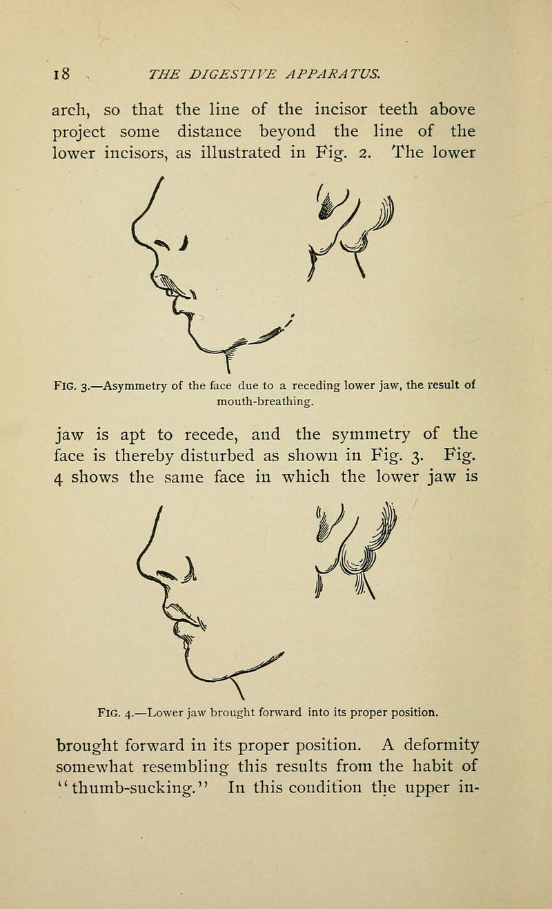 arch, so that the line of the incisor teeth above project some distance beyond the line of the lower incisors, as illustrated in Fig. 2. The lower Fig. 3.—Asymmetry of the face due to a receding lower jaw, the result of mouth-breathing. jaw is apt to recede, and the symmetry of the face is thereby disturbed as shown in Fig. 3. Fig. 4 shows the same face in which the lower jaw is Fig. 4.—Lower jaw brought forward into its proper position. brought forward in its proper position. A deformity somewhat resembling this results from the habit of ^'thumb-sucking, In this condition the upper in-