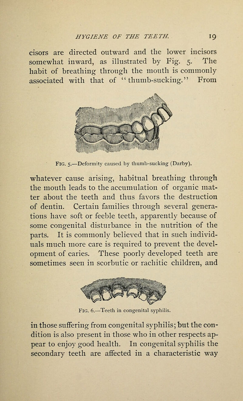 cisors are directed outward and the lower incisors somewhat inward, as illustrated by Fig. 5. The habit of breathing through the mouth is commonly associated with that of thumb-sucking. From Fig. 5.—Deformity caused by thumb-sucking (Darby). whatever cause arising, habitual breathing through the mouth leads to the accumulation of organic mat- ter about the teeth and thus favors the destruction of dentin. Certain families through several genera- tions have soft or feeble teeth, apparently because of some congenital disturbance in the nutrition of the parts. It is commonly believed that in such individ- uals much more care is required to prevent the devel- opment of caries. These poorly developed teeth are sometimes seen in scorbutic or rachitic children, and Fig. 6.—Teeth in congenital syphilis. in those suffering from congenital syphilis; but the con- dition is also present in those who in other respects ap- pear to enjoy good health. In congenital syphilis the secondary teeth are affected in a characteristic way