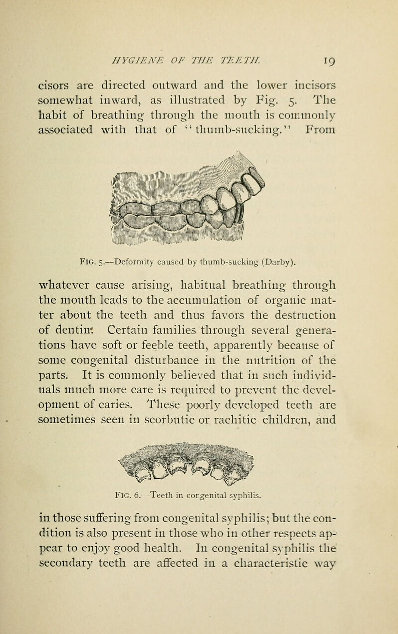 cisors are directed outward and the lower incisors somewhat inward, as ilhistrated by Fi<^. 5. The habit of breathing through the mouth is commonly associated with that of thumb-sucking. From liiHllii,ll,„iJilut ™i(i|iuiiii>i'» '•*' Fig. 5.—Deformity caused by thumb-sucking (Darby). whatever cause arising, habitual breathing through the mouth leads to the accumulation of organic mat- ter about the teeth and thus favors the destruction of dentin'. Certain families through several genera- tions have soft or feeble teeth, apparently because of some congenital disturbance in the nutrition of the parts. It is commonly believed that in such individ- uals much more care is required to prevent the devel- opment of caries. These poorly developed teeth are sometimes seen in scorbutic or rachitic children, and Fig. 6.—Teeth in congenital syphihs. in those suffering from congenital syphilis; but the con- dition is also present in those wdio in other respects ap- pear to enjoy good health. In congenital syphilis the secondary teeth are affected in a characteristic way