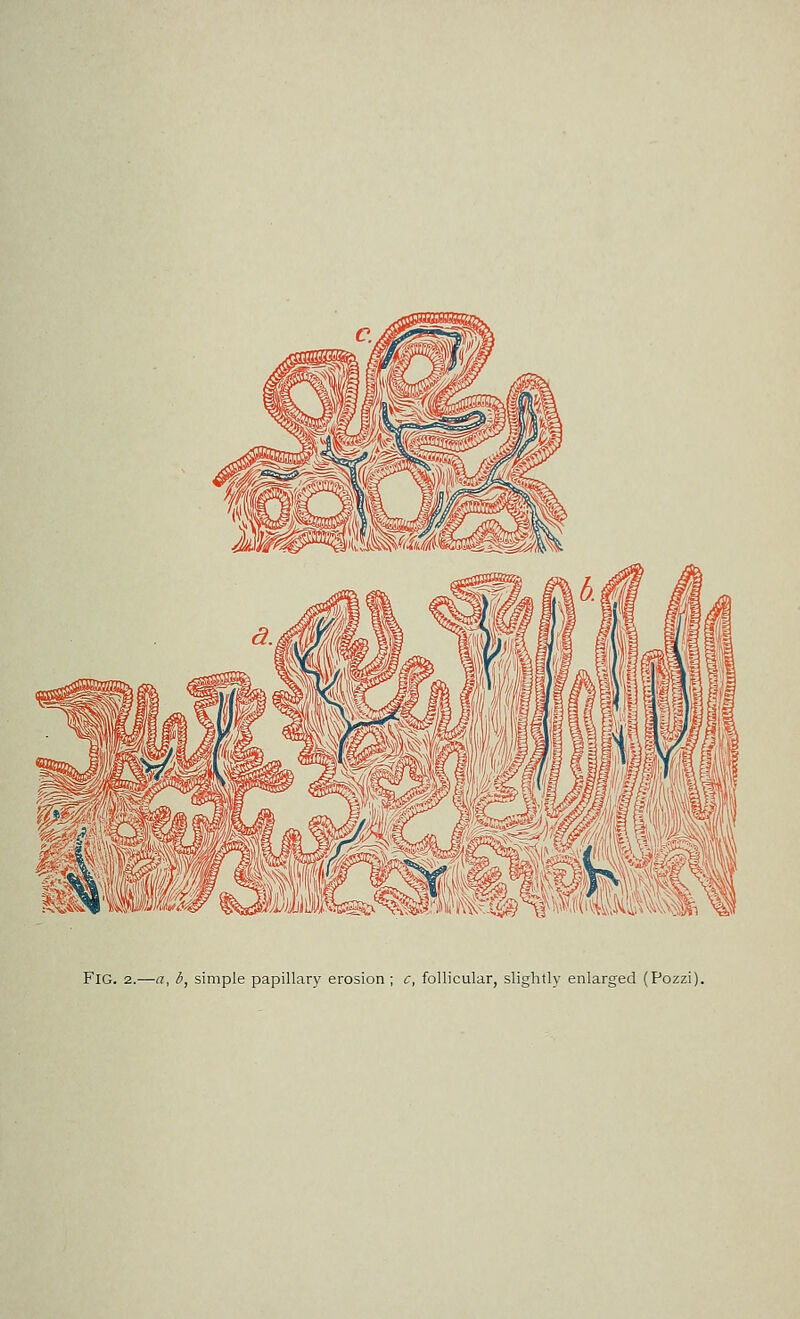 Fig. 2.—«, b, simple papillary erosion; c, follicular, slightly enlarged (Pozzi).