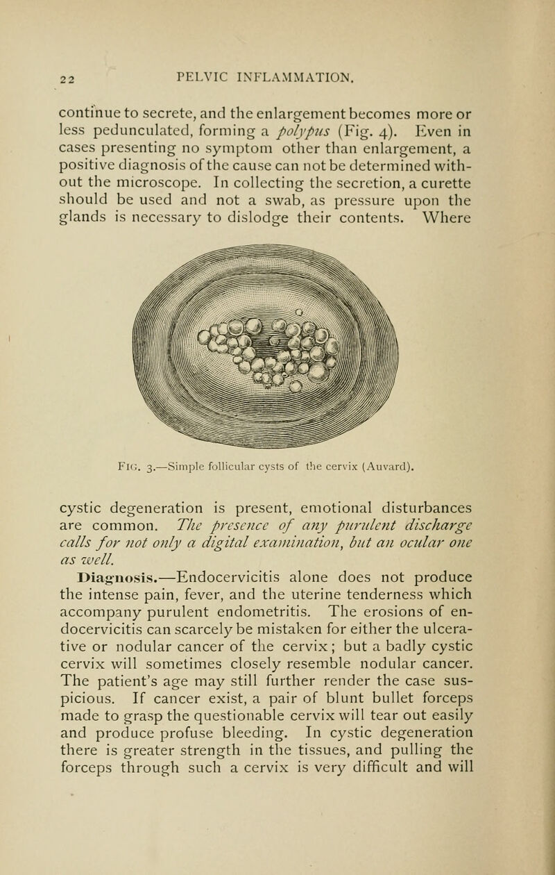 continue to secrete, and the enlargement becomes more or less pedunculated, forming a polypus (Fig. 4). Even in cases presenting no symptom other than enlargement, a positive diagnosis of the cause can not be determined with- out the microscope. In collecting the secretion, a curette should be used and not a swab, as pressure upon the glands is necessary to dislodge their contents. Where Fk;. 3.—Simple follicular cysts of the cervix (Auvard). cystic degeneration is present, emotional disturbances are common. Tlie presence of any purulent discharge calls for not only a digital exajiiination, but an ocular one as zvell. Diag-nosis.—Endocervicitis alone does not produce the intense pain, fever, and the uterine tenderness which accompany purulent endometritis. The erosions of en- docervicitis can scarcely be mistaken for either the ulcera- tive or nodular cancer of the cervix; but a badly cystic cervix will sometimes closely resemble nodular cancer. The patient's age may still further render the case sus- picious. If cancer exist, a pair of blunt bullet forceps made to grasp the questionable cervix will tear out easily and produce profuse bleeding. In cystic degeneration there is greater strength in the tissues, and pulling the forceps through such a cervix is very difficult and will