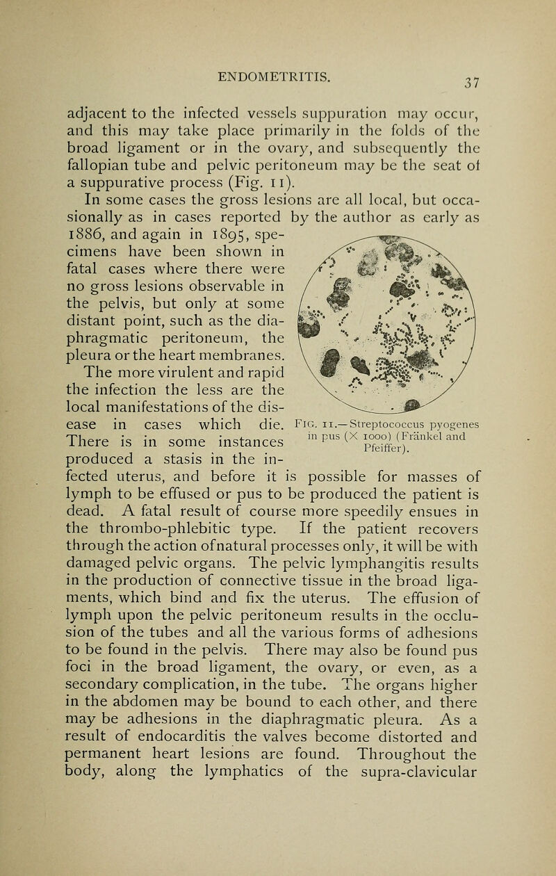 adjacent to the infected vessels suppuration may occur, and this may take place primarily in the folds of the broad ligament or in the ovary, and subsequently the fallopian tube and pelvic peritoneum may be the seat ot a suppurative process (Fig. ii). In some cases the gross lesions are all local, but occa- sionally as in cases reported by the author as early as 1886, and again in 1895, spe- cimens have been shown in fatal cases where there were no gross lesions observable in the pelvis, but only at some distant point, such as the dia- phragmatic peritoneum, the pleura or the heart membranes. The more virulent and rapid the infection the less are the local manifestations of the dis- which die. ease m Fig. II.— Streptococcus pyogenes in pus (X 1000) (Frankel and Pfeiffer). cases There is in some instances produced a stasis in the in- fected uterus, and before it is possible for masses of lymph to be effused or pus to be produced the patient is dead. A fatal result of course more speedily ensues in the thrombo-phlebitic type. If the patient recovers through the action ofnatural processes only, it will be with damaged pelvic organs. The pelvic lymphangitis results in the production of connective tissue in the broad liga- ments, which bind and fix the uterus. The effusion of lymph upon the pelvic peritoneum results in the occlu- sion of the tubes and all the various forms of adhesions to be found in the pelvis. There may also be found pus foci in the broad ligament, the ovary, or even, as a secondary complication, in the tube. The organs higher in the abdomen may be bound to each other, and there may be adhesions in the diaphragmatic pleura. As a result of endocarditis the valves become distorted and permanent heart lesions are found. Throughout the body, along the lymphatics of the supra-clavicular
