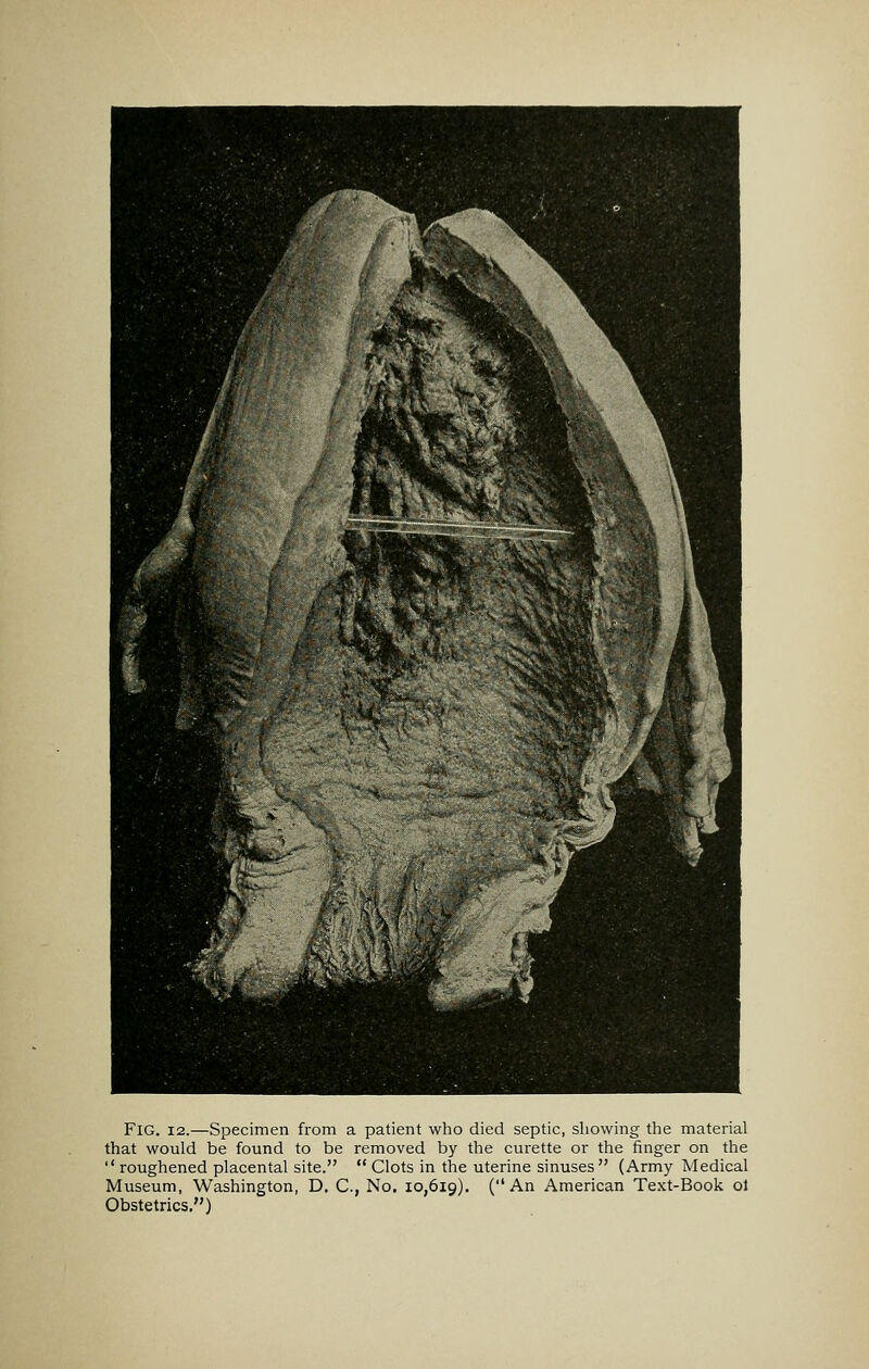 Fig. 12.—Specimen from a patient who died septic, showing the material that would be found to be removed by the curette or the finger on the  roughened placental site.  Clots in the uterine sinuses (Army Medical Museum, Washington, D. C, No. 10,619). (An American Text-Book ol Obstetrics.)