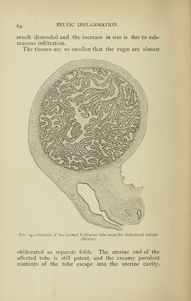 much' distended and the increase in size is due to sub- mucous infiltration. The tissues are so swollen that the rugae are almost :^^ ll^ Fk;. 14.—Section of the normal Fallopian tube near the abdorninal ostinm (Beyea). obliterated as separate folds. The uterine end of the affected tube is still patent, and the creamy purulent contents of the tube escape into the uterine cavity.