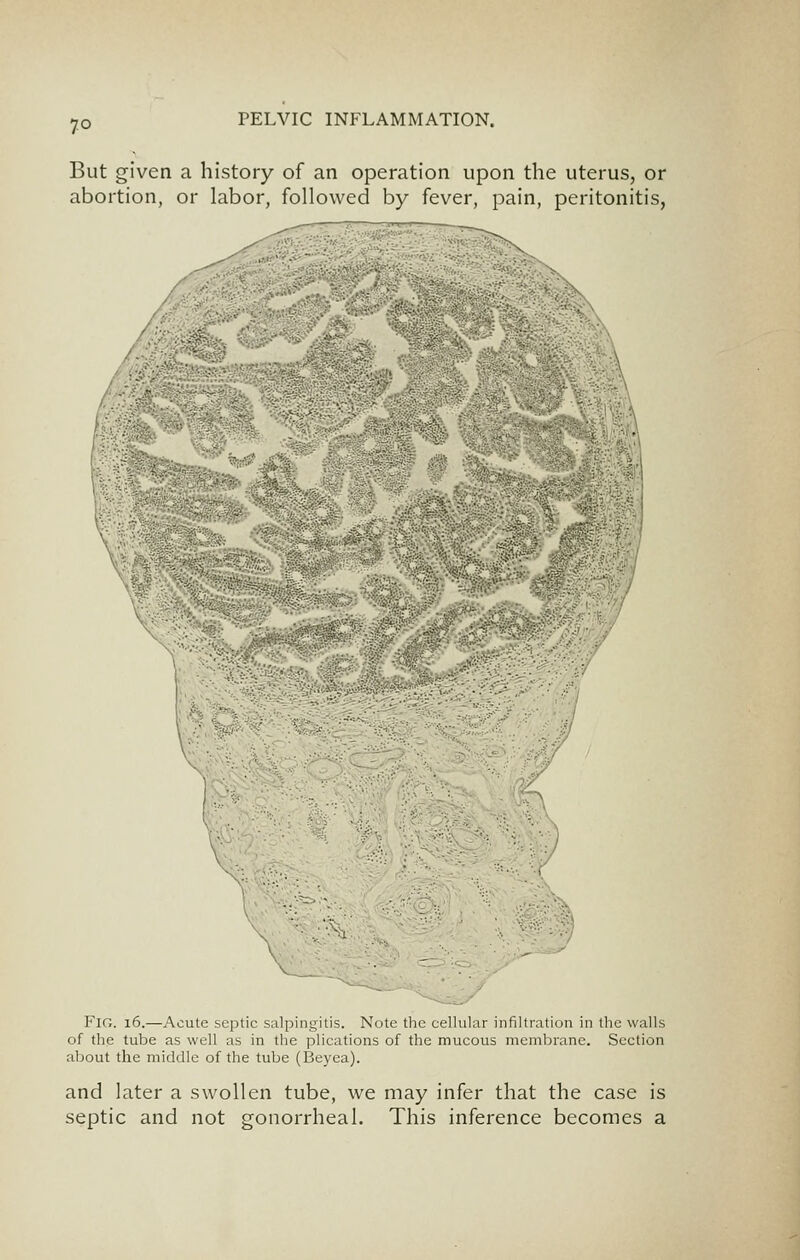 But given a history of an operation upon the uterus, or abortion, or labor, followed by fever, pain, peritonitis, •-. .. '■■'■'■ .J;.-fovS-. H. Fig. i6.—Acute septic salpingitis. Note the cellular infiltration in the walls of the tube as well as in the plications of the mucous membrane. Section aljout the middle of the tube (Beyea). and later a swollen tube, we may infer that the case is septic and not gonorrheal. This inference becomes a