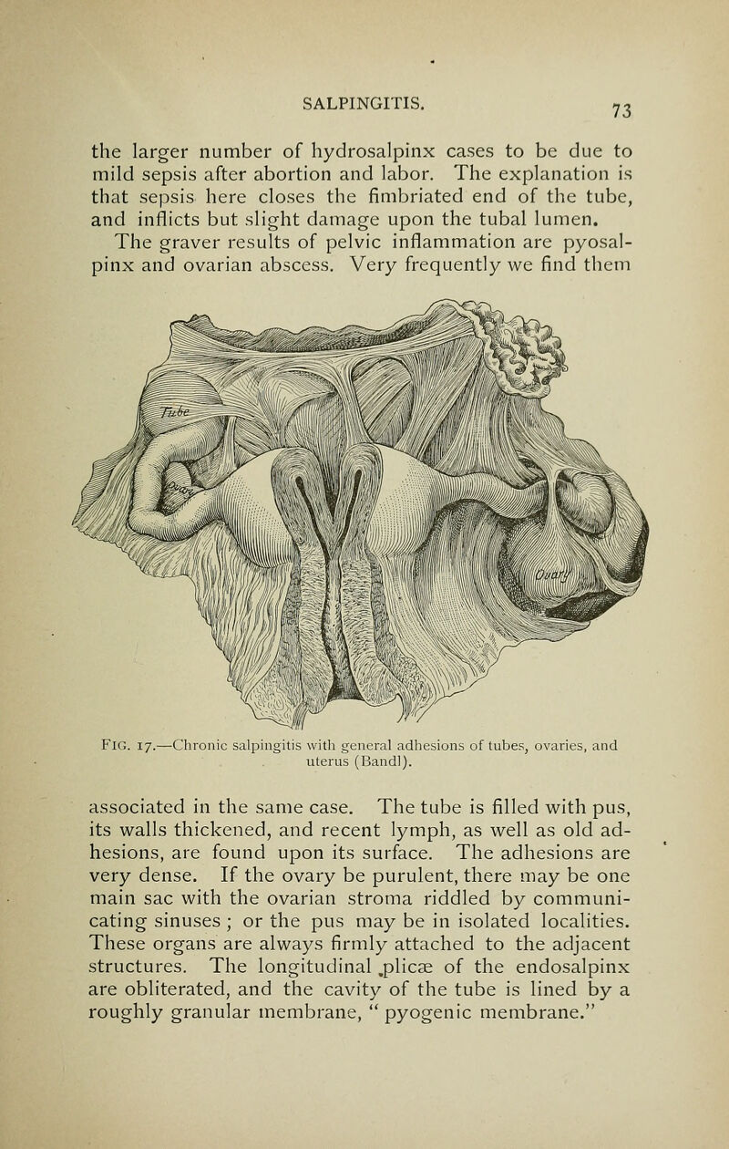 the larger number of hydrosalpinx cases to be due to mild sepsis after abortion and labor. The explanation is that sepsis here closes the fimbriated end of the tube, and inflicts but slight damage upon the tubal lumen. The graver results of pelvic inflammation are pyosal- pinx and ovarian abscess. Very frequently we find them Fig. 17.—Chronic salpingitis witli general adhesions of tubes, ovaries, and uterus (Bandl). associated in the same case. The tube is filled with pus, its walls thickened, and recent lymph, as well as old ad- hesions, are found upon its surface. The adhesions are very dense. If the ovary be purulent, there may be one main sac with the ovarian stroma riddled by communi- cating sinuses ; or the pus may be in isolated localities. These organs are always firmly attached to the adjacent structures. The longitudinal .plicae of the endosalpinx are obliterated, and the cavity of the tube is lined by a roughly granular membrane,  pyogenic membrane.