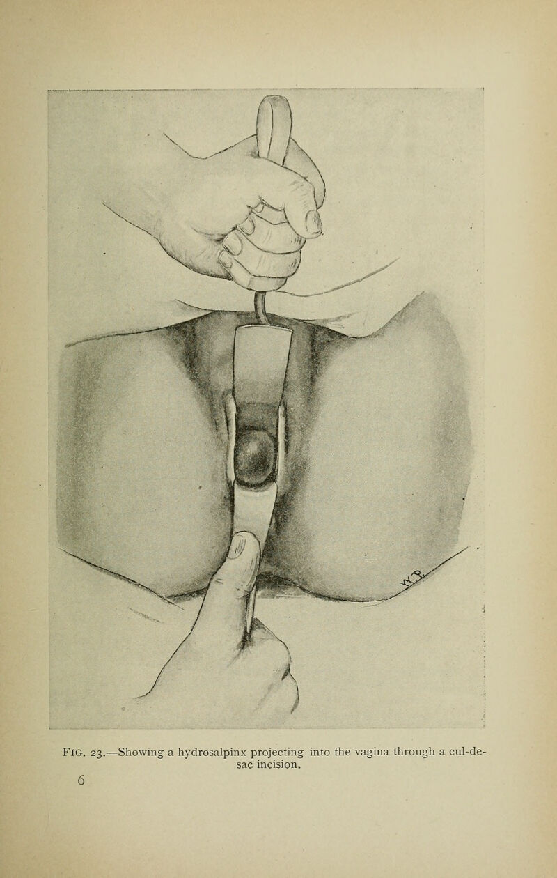Fig. 23.—Showing a hydrosalpinx projecting into the vagina through a cul-de- sac incision.