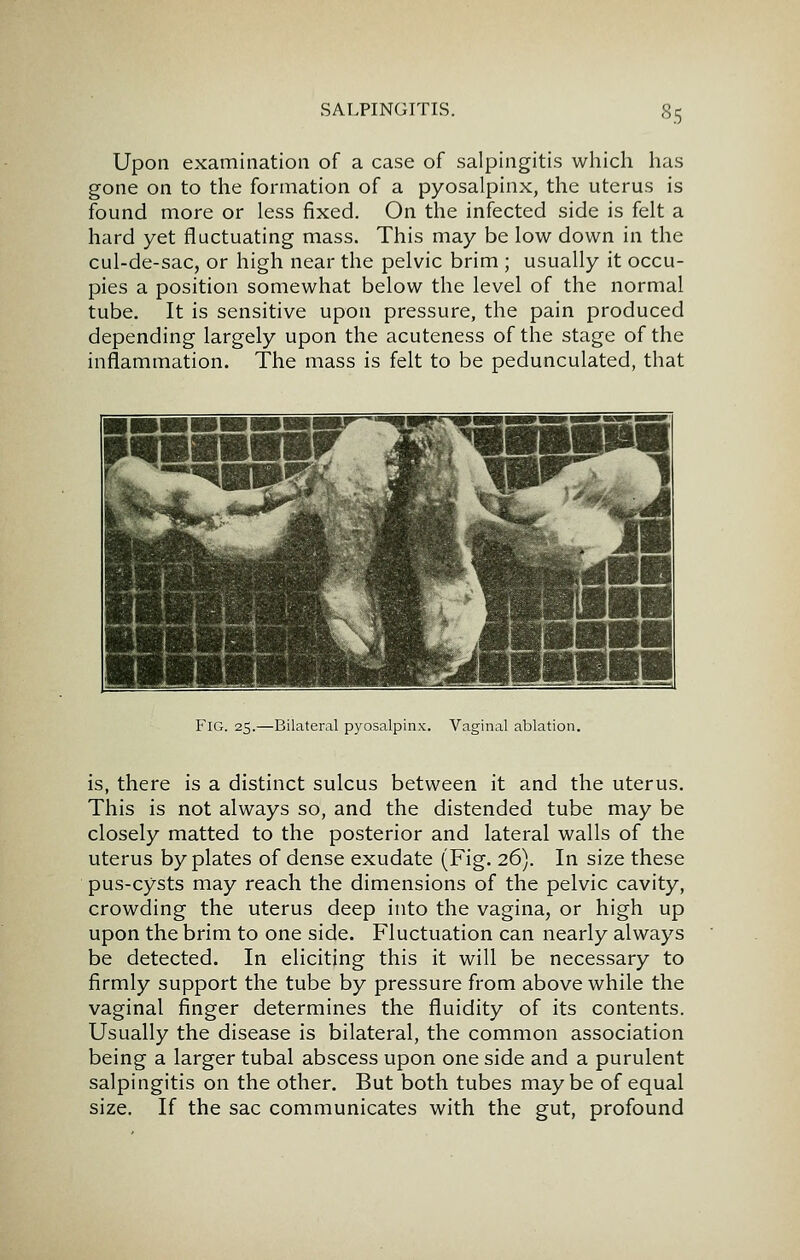 Upon examination of a case of salpingitis which has gone on to the formation of a pyosalpinx, the uterus is found more or less fixed. On the infected side is felt a hard yet fluctuating mass. This may be low down in the cul-de-sac, or high near the pelvic brim ; usually it occu- pies a position somewhat below the level of the normal tube. It is sensitive upon pressure, the pain produced depending largely upon the acuteness of the stage of the inflammation. The mass is felt to be pedunculated, that Fig. 25.—Bilateral pyosalpinx. Vaginal ablation. is, there is a distinct sulcus between it and the uterus. This is not always so, and the distended tube may be closely matted to the posterior and lateral walls of the uterus by plates of dense exudate (Fig. 26). In size these pus-cysts may reach the dimensions of the pelvic cavity, crowding the uterus deep into the vagina, or high up upon the brim to one side. Fluctuation can nearly always be detected. In eliciting this it will be necessary to firmly support the tube by pressure from above while the vaginal finger determines the fluidity of its contents. Usually the disease is bilateral, the common association being a larger tubal abscess upon one side and a purulent salpingitis on the other. But both tubes maybe of equal size. If the sac communicates with the gut, profound