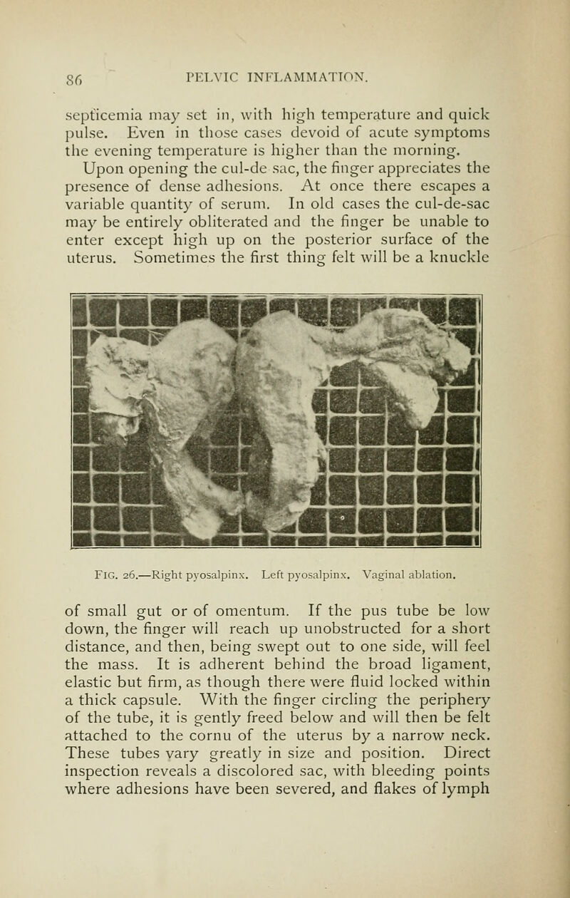septicemia may set in, with high temperature and quick pulse. Even in those cases devoid of acute symptoms the evening temperature is higher than the morning. Upon opening the cul-de sac, the finger appreciates the presence of dense adhesions. At once there escapes a variable quantity of serum. In old cases the cul-de-sac may be entirely obliterated and the finger be unable to enter except high up on the posterior surface of the uterus. Sometimes the first thing felt will be a knuckle Fig. 26.—Right pyosalpinx. Left pyosalpinx. Vaginal ablation. of small gut or of omentum. If the pus tube be low down, the finger will reach up unobstructed for a short distance, and then, being swept out to one side, will feel the mass. It is adherent behind the broad ligament, elastic but firm, as though there were fluid locked within a thick capsule. With the finger circling the periphery of the tube, it is gently freed below and will then be felt attached to the cornu of the uterus by a narrow neck. These tubes vary greatly in size and position. Direct inspection reveals a discolored sac, with bleeding points where adhesions have been severed, and flakes of lymph