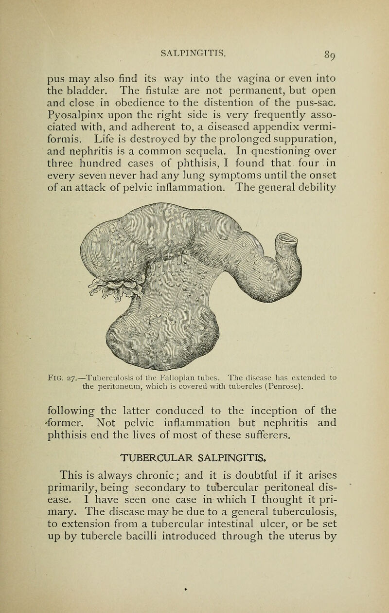 pus may also find its way into the vagina or even into the bladder. The fistulse are not permanent, but open and close in obedience to the distention of the pus-sac. Pyosalpinx upon the right side is very frequently asso- ciated with, and adherent to, a diseased appendix vermi- formis. Life is destroyed by the prolonged suppuration, and nephritis is a common sequela. In questioning over three hundred cases of phthisis, I found that four in every seven never had any lung symptoms until the onset of an attack of pelvic inflammation. The general debility Fig. 27.—Tuberculosis of the Fallopian tubes. The disease has extended to the peritoneum, which is covered with tubercles (Penrose). following the latter conduced to the inception of the -former. Not pelvic inflammation but nephritis and phthisis end the lives of most of these sufferers. TUBERCULAR SALPINGITIS. This is always chronic; and it is doubtful if it arises primarily, being secondary to tubercular peritoneal dis- ease. I have seen one case in which I thought it pri- mary. The disease may be due to a general tuberculosis, to extension from a tubercular intestinal ulcer, or be set up by tubercle bacilli introduced through the uterus by