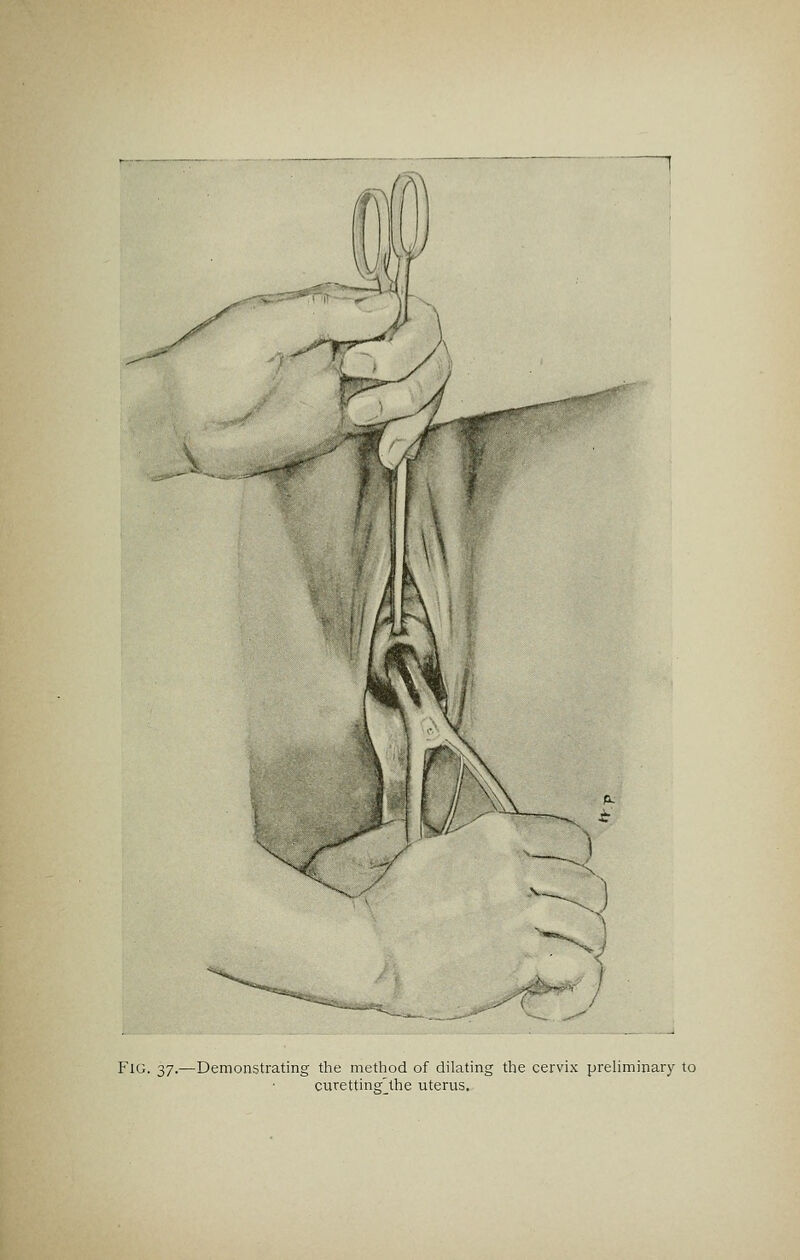 Fig. 37.—Demonstrating the method of dilating the cervix preliminary to curetting'the uterus.