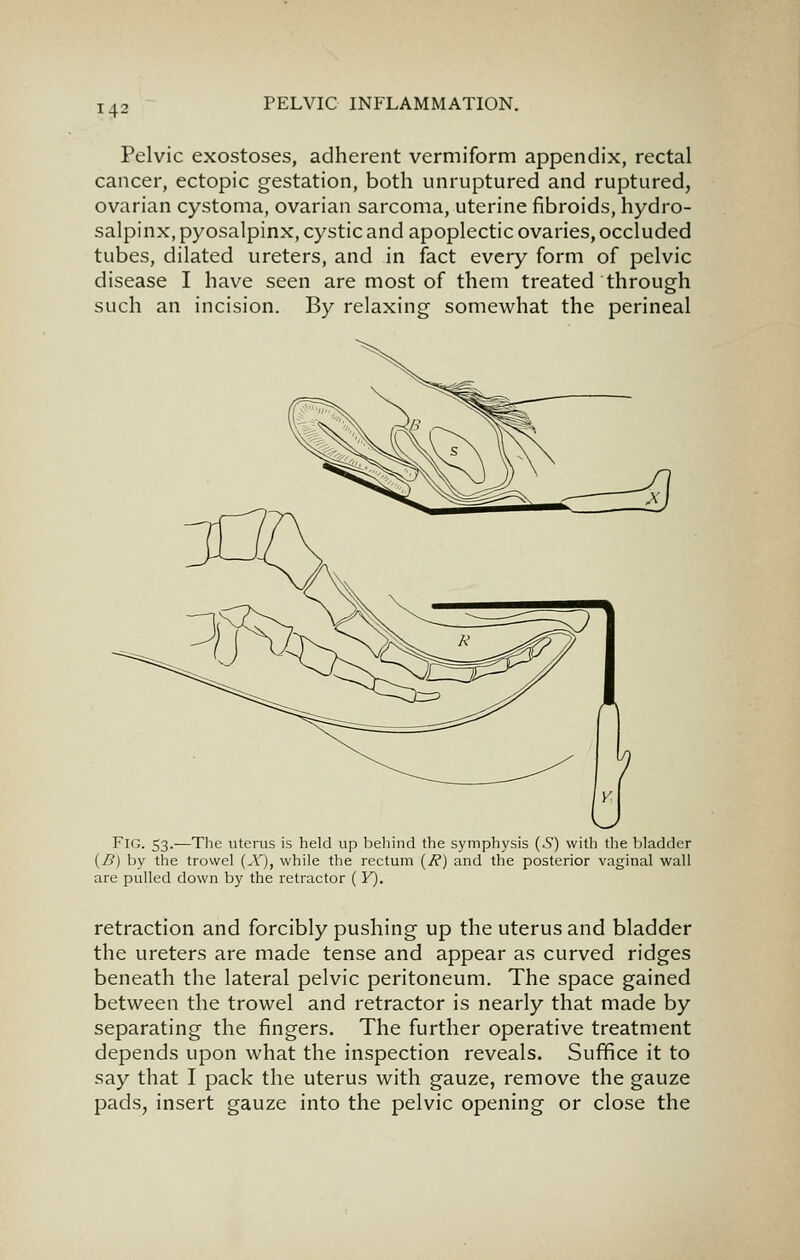 i4i Pelvic exostoses, adherent vermiform appendix, rectal cancer, ectopic gestation, both unruptured and ruptured, ovarian cystoma, ovarian sarcoma, uterine fibroids, hydro- salpinx, pyosalpinx, cystic and apoplectic ovaries, occluded tubes, dilated ureters, and in fact every form of pelvic disease I have seen are most of them treated through such an incision. By relaxing somewhat the perineal Fig. 53.—The uterus is held up behind the symphysis (5) with the bladder {B) by the trowel (X), while the rectum {J?) and the posterior vaginal wall are pulled down by the retractor ( V). retraction and forcibly pushing up the uterus and bladder the ureters are made tense and appear as curved ridges beneath the lateral pelvic peritoneum. The space gained between the trowel and retractor is nearly that made by separating the fingers. The further operative treatment depends upon what the inspection reveals. Suffice it to say that I pack the uterus with gauze, remove the gauze pads, insert gauze into the pelvic opening or close the