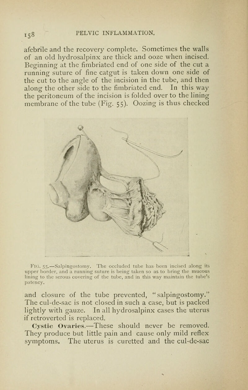 afebrile and the recovery complete. Sometimes the walls of an old hydrosalpinx are thick and ooze when incised. Beginning at the fimbriated end of one side of the cut a running suture of fine catgut is taken down one side of the cut to the angle of the incision in the tube, and then along the other side to the fimbriated end. In this way the peritoneum of the incision is folded over to the lining membrane of the tube (Fig. 55). Oozing is thus checked '^. Fu;. 55.—Salpingostomy. The occluded tube has been incised along its upper border, and a running suture is being taken so as to bring the mucous lining to the serous covering of the tube, and in this way maintain the tube's patency. and closure of the tube prevented, salpingostomy. The cul-de-sac is not closed in such a case, but is packed lightly with gauze. In all hydrosalpinx cases the uterus if retroverted is replaced. Cystic Ovaries.—These should never be removed. They produce but little pain and cause only mild reflex symptoms. The uterus is curetted and the cul-de-sac
