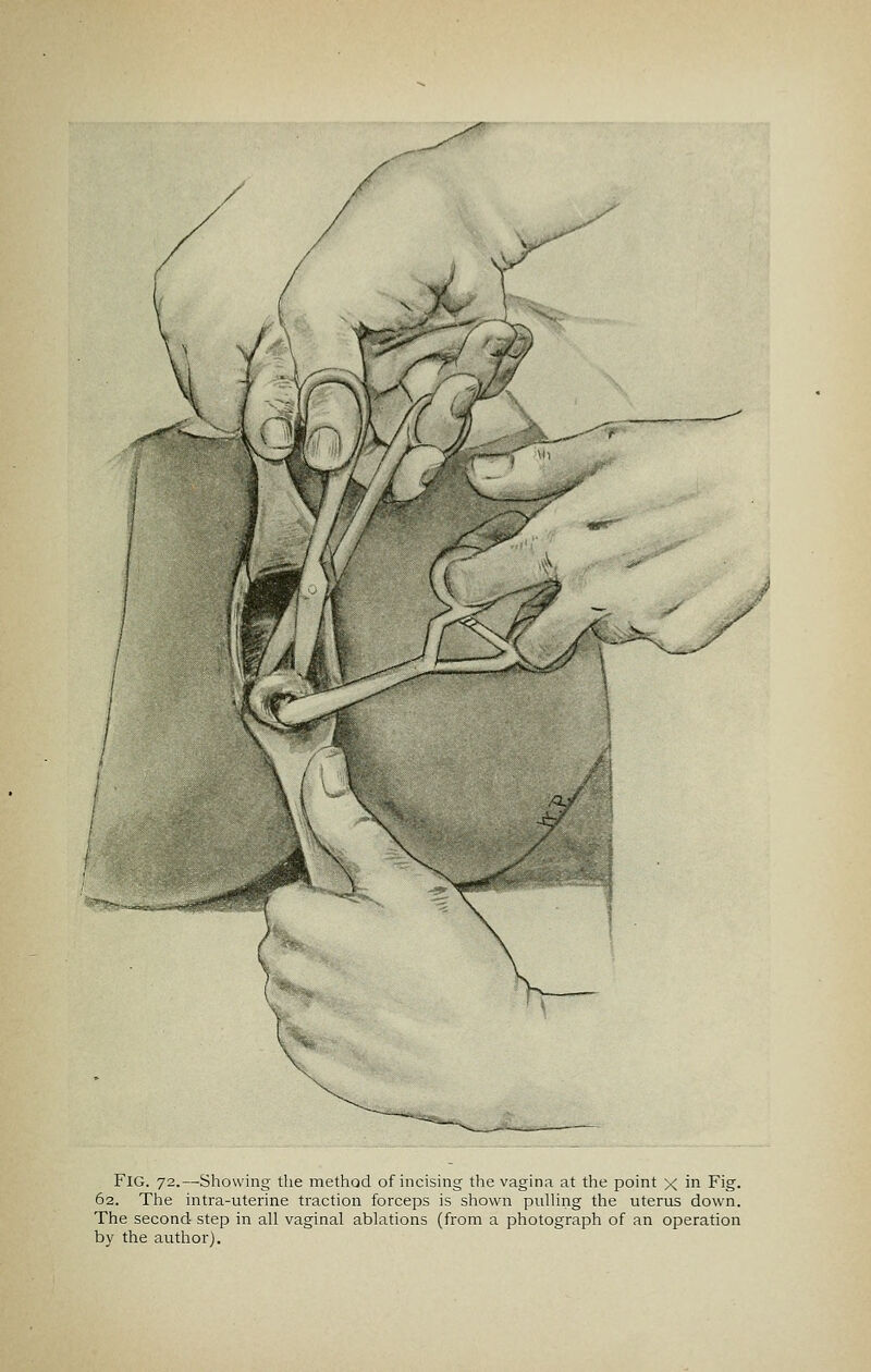 Fig. 72.—Showing the method of incising the vagina at the point x in Fig. 62. The intra-uterine traction forceps is shown pulling the uterus down. The second step in all vaginal ablations (from a photograph of an operation by the author).