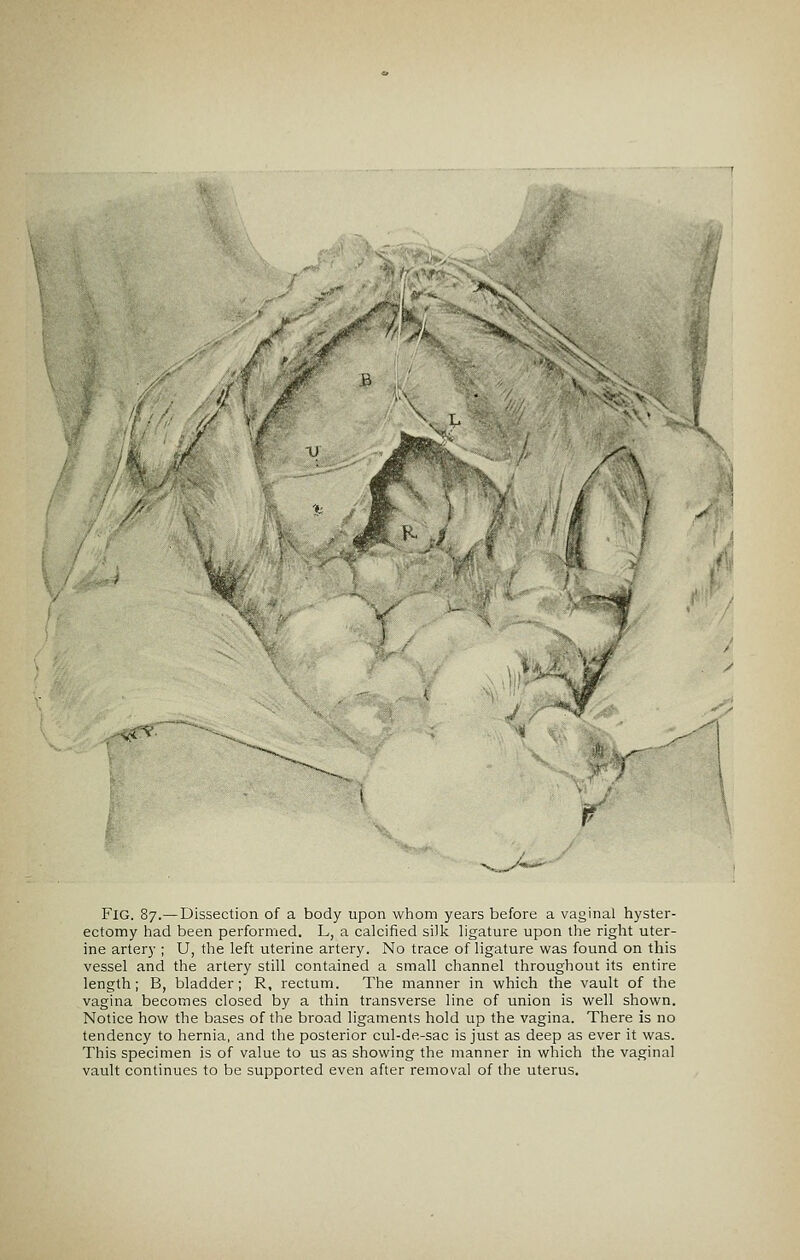 >%.•.. 1 4 / \ P ^^^^^-l«„Mi^ ■ Fig. 87.— Dissection of a body upon whom years before a vaginal hyster- ectomy had been performed. L, a calcified silk hgature upon the right uter- ine artery ; U, the left uterine artery. No trace of ligature was found on this vessel and the artery still contained a small channel throughout its entire length; B, bladder; R, rectum. The manner in which the vault of the vagina becomes closed by a thin transverse line of union is well shown. Notice how the bases of the broad ligaments hold up the vagina. There is no tendency to hernia, and the posterior cul-de-sac is just as deep as ever it was. This specimen is of value to us as showing the manner in which the vaginal vault continues to be supported even after removal of the uterus.