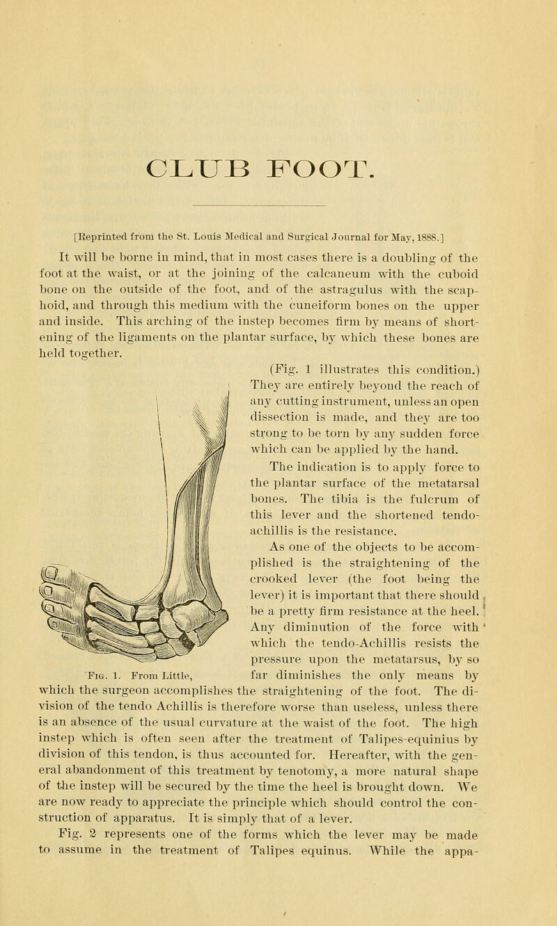 CLUB FOOT. [Reprinted from the St. Louis Medical and Surgical Journal for May, 1888.] It will be borne in mind, that in most cases there is a doubling of the foot at the waist, or at the joining of the calcaneum with the cuboid bone on the outside of the foot, and of the astragulus with the scap- hoid, and through this medium with the cuneiform bones on the upper and inside. This arching of the instep becomes firm by means of short- ening of the ligaments on the plantar surface, by which these bones are held together. (Fig. 1 illustrates this condition.) They are entirely beyond the reach of any cutting instrument, unless an open dissection is made, and they are too strong to be torn by any sudden force which can be applied by the hand. The indication is to apply force to the plantar surface of the metatarsal bones. The tibia is the fulcrum of this lever and the shortened tendo- achillis is the resistance. As one of the objects to be accom- plished is the straightening of the crooked lever (the foot being the lever) it is important that there should , be a pretty firm resistance at the heel.' Any diminution of the force with ' which the tendo-Achillis resists the pressure upon the metatarsus, by so far diminishes the only means by which the surgeon accomplishes the straightening of the foot. The di- vision of the tendo Achillis is therefore worse than useless, unless there is an absence of the usual curvature at the waist of the foot, The high instep which is often seen after the treatment of Talipes-equinius by division of this tendon, is thus accounted for. Hereafter, with the gen- eral abandonment of this treatment by tenotomy, a more natural shape of the instep will be secured by the time the heel is brought down. We are now ready to appreciate the principle which should control the con- struction of apparatus. It is simply that of a lever. to assume in the treatment of Talipes equinus. While the appa- Fig. 1. From Little,