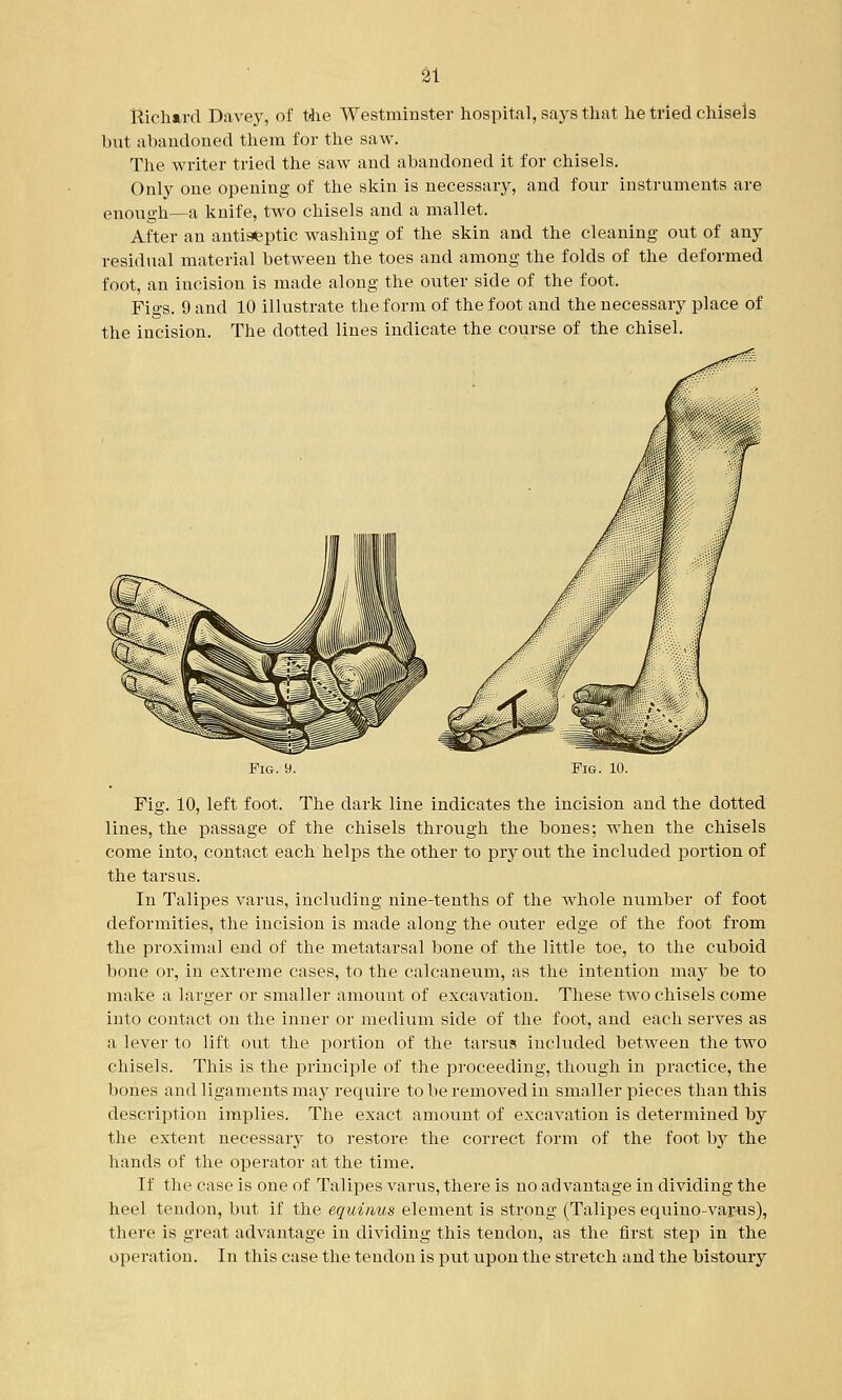 Richard Davey, of the Westminster hospital, says that he tried chisels but abandoned them for the saw. The writer tried the saw and abandoned it for chisels. Only one opening of the skin is necessary, and four instruments are enough—a knife, two chisels and a mallet. After an antiseptic washing of the skin and the cleaning out of any residual material between the toes and among the folds of the deformed foot, an incision is made along the outer side of the foot. Figs. 9 and 10 illustrate the form of the foot and the necessary place of the incision. The dotted lines indicate the course of the chisel. Fig. 9. Fi&. 10. Fig. 10, left foot. The dark line indicates the incision and the dotted lines, the passage of the chisels through the bones; when the chisels come into, contact each helps the other to pry out the included portion of the tarsus. In Talipes varus, including nine-tenths of the whole number of foot deformities, the incision is made along the outer edge of the foot from the proximal end of the metatarsal bone of the little toe, to the cuboid bone or, in extreme cases, to the calcaneum, as the intention may be to make a larger or smaller amount of excavation. These two chisels come into contact on the inner or medium side of the foot, and each serves as a lever to lift out the portion of the tarsus included between the two chisels. This is the principle of the proceeding, though in practice, the bones and ligaments may require to be removed in smaller pieces than this description implies. The exact amount of excavation is determined by the extent necessary to restore the correct form of the foot by the hands of the operator at the time. If the case is one of Talipes varus, there is no advantage in dividing the heel tendon, but if the equinus element is strong (Talipes equino-varus), there is great advantage in dividing this tendon, as the first step in the operation. In this case the tendon is put upon the stretch and the bistoury