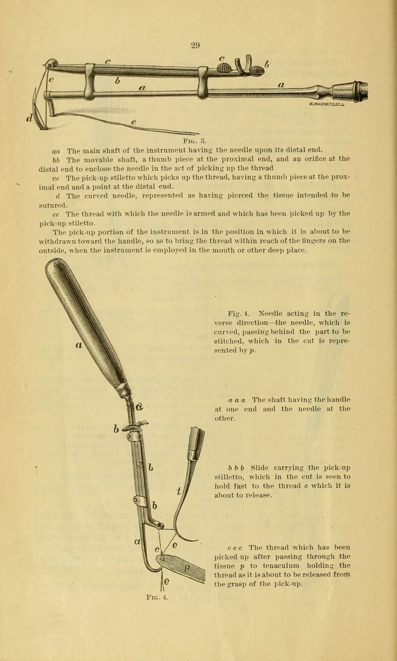 Fig. 3. aa The main shaft of the instrument having the needle upon its distal end. 66 The movable shaft, a thumb piece at the proximal end, and an orifice at the distal end to enclose the needle in the act of picking up the thread c.c The pick-up stiletto which picks up the thread, having a thumb piece at the prox- imal end and a point at the distal end. d The curved needle, represented as having pierced the tissue intended to be sutured. ee The thread with which the needle is armed and which has been picked up by the pick-up stiletto. The pick-up portion of the instrument is in the position in which it is about to be withdrawn toward the handle, so as to bring the thread within reach of the fingers on the outside, when the instrument is employed in the mouth or other deep place. Fig. 4. Needle acting in the re- verse direction—the needle, which is curved, passing behind the part to be stitched, which in the cut is repre- sented by p. a a a The shaft having the handle at one end and the needle at the other. 6 6b Slide carrying the pick-up stilletto, which in the cut is seen to hold fast to the thread c which it is about to release. c c e The thread which has been picked up after passing through the tissue p to tenaculum holding the thread as it is about to be released from the grasp of the pick-up.