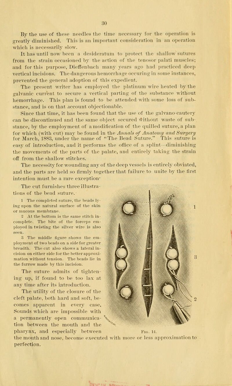 By the use of these needles the time necessary for the operation is greatly diminished. This is an important consideration in an operation which is necessarily slow. It lias until now been a desideratum to protect the shallow sutures from the strain occasioned by the action of the tenosor palati muscles; and for this purpose, Dieffenbach many years ago had practiced deep vertical incisions. The dangerous hemorrhage occuring in some instances, prevented the general adoption of this expedient. The present writer has employed the platinum wire heated by the galvanic current to secure a vertical parting of the substance without hemorrhage. This plan is found to be attended with some loss of sub- stance, and is on that account objectionable. Since that time, it has been found that the use of the galvano-cautery can be discontinued and the same object secured without waste of sub-, stance, by the employment of a modification of the quilled suture, a plan for which (with cut) may be found in the Annals of Anatomy and Surgery for March, 1883, under the name of The Bead Suture. This suture is easy of introduction, and it performs the office of a splint—diminishing the movements of the parts of the palate, and entirely taking the strain off from the shallow stitches. The necessity for wounding any of the deep vessels is entirely obviated, and the parts are held so firmly together that failure to unite by the first intention must be a rare exception- The cut furnishes three illustra- tions of the bead suture. 1 The completed suture, the beads ly- ing upon the natural surface of the skin ;s?g or mucous membrane. 2 At the bottom is the same stitch in- complete. The bite of the forceps em- ployed in twisting the silver wire is also seen. 3 The middle figure shows the em- ployment of two beads on a side for greater breadth. The cut also shows a lateral in- cision on either side for the better approxi- I matron without tension. The beads lie in the furrow made by this incision. The suture admits of tighten- ing up, if found to be too lax at any time after its introduction. The utility of the closure of the cleft palate, both hard and soft, be- comes apparent in every case. Sounds which are impossible with a permanently open communica- V tion between the mouth and the N pharynx, and especially between Pis. 14. the mouth and nose, become executed with more or less approximation to perfection.