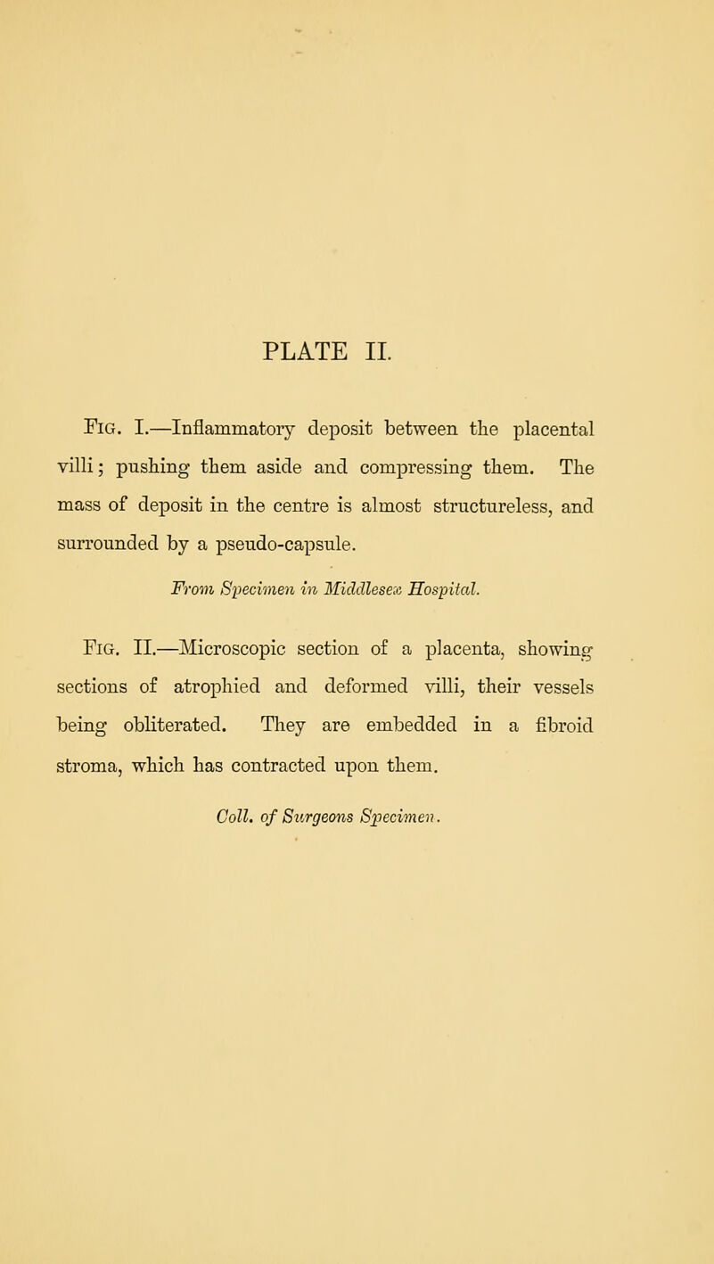 Fig. I.—Inflammatory deposit between the placental villi; pushing them aside and compressing them. The mass of deposit in the centre is almost structureless, and surrounded by a pseudo-capsule. From Specimen in Middlesex Hospital. Fig. II.—Microscopic section of a placenta, showing sections of atrophied and deformed villi, their vessels being obliterated. Tliey are embedded in a fibroid stroma, which has contracted upon them. Coll. of Surgeons Specimen.