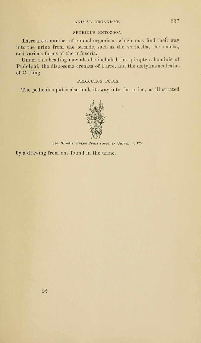 SPURIOUS ENTOZOOA. There are a number of animal organisms which may find their way into the urine from the outside, such as the vorticella, the amoeba, and various forms of the infusoria. Under this heading may also be included the spiroptera hominis of Eudolphi, the disposoma crenata of Farre, and the dtctylius aeuleatus of Curling. PEDICULUS PUBIS. The pediculus pubis also finds its way into the urine, as illustrated Fig. 99.—Pediculus Pubis found in Urine. X 125. by a drawing from one found in the urine. 23