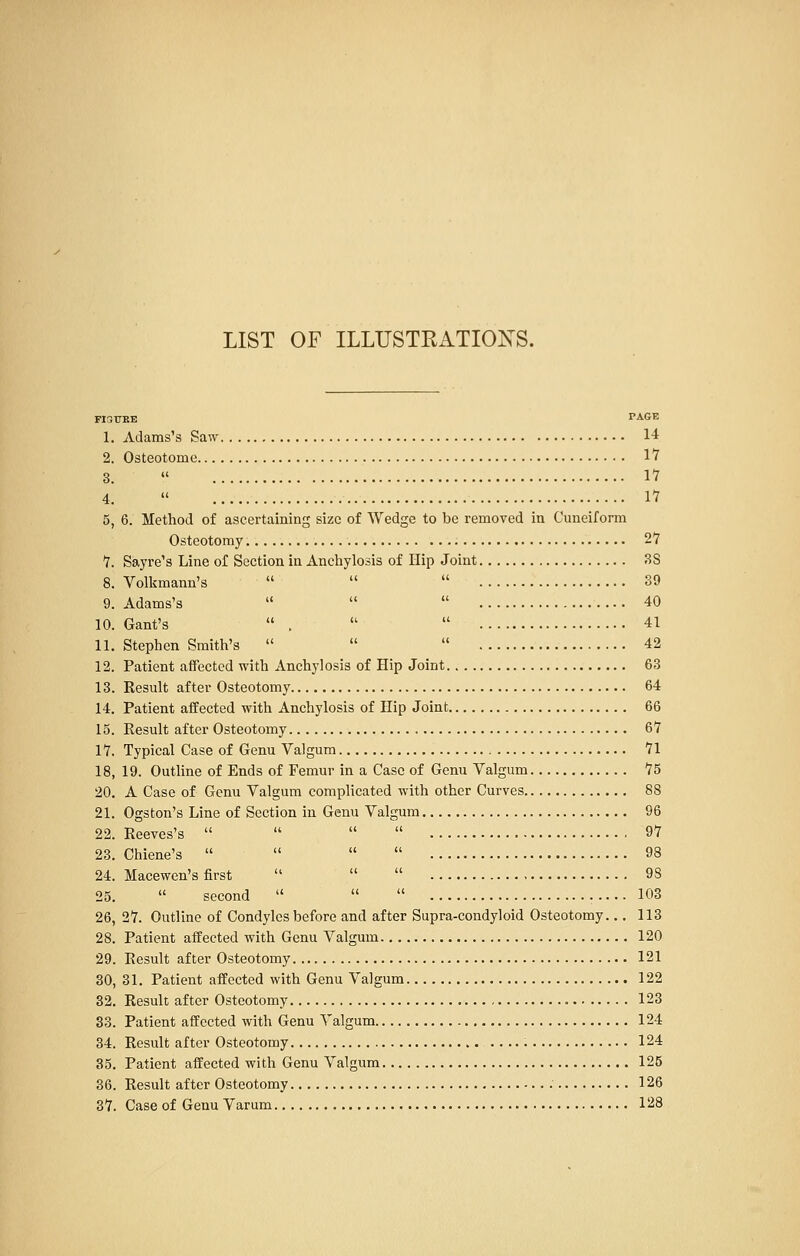 FlaiTRE PAGE 1. Adams's Saw 14 2. Osteotome 17 3.  17 4.  17 5. 6. Method of ascertaining size of Wedge to be removed in Cuneiform Osteotomy 27 7. Sayre's Line of Section in Anchylosis of Hip Joint 3S 8. Volkmann's    39 9. Adams's    40 10. Gant's  ,   41 11. Stephen Smith's    42 12. Patient affected with Anchylosis of Hip Joint 63 13. Result after Osteotomy 64 14. Patient affected with Anchylosis of Hip Joint 66 15. Eesult after Osteotomy 67 17. Typical Case of Genu Valgum 71 18, 19. Outline of Ends of Femur in a Case of Genu Valgum 75 20. A Case of Genu Valgum complicated with other Curves 88 21. Ogston's Line of Section in Genu Valgum 96 22. Reeves's     97 23. Chiene's     98 24. Macewen's first    98 25.  second    103 26. 27. Outline of Condyles before and after Supra-condyloid Osteotomy... 113 28. Patient affected with Genu Valgum 120 29. Result after Osteotomy 121 30. 31. Patient affected with Genu Valgum 122 32. Result after Osteotomy 123 33. Patient affected with Genu Valgum 124 34. Result after Osteotomy 124 35. Patient affected with Genu Valgum 125 36. Result after Osteotomy 126 37. Case of Genu Varum 128