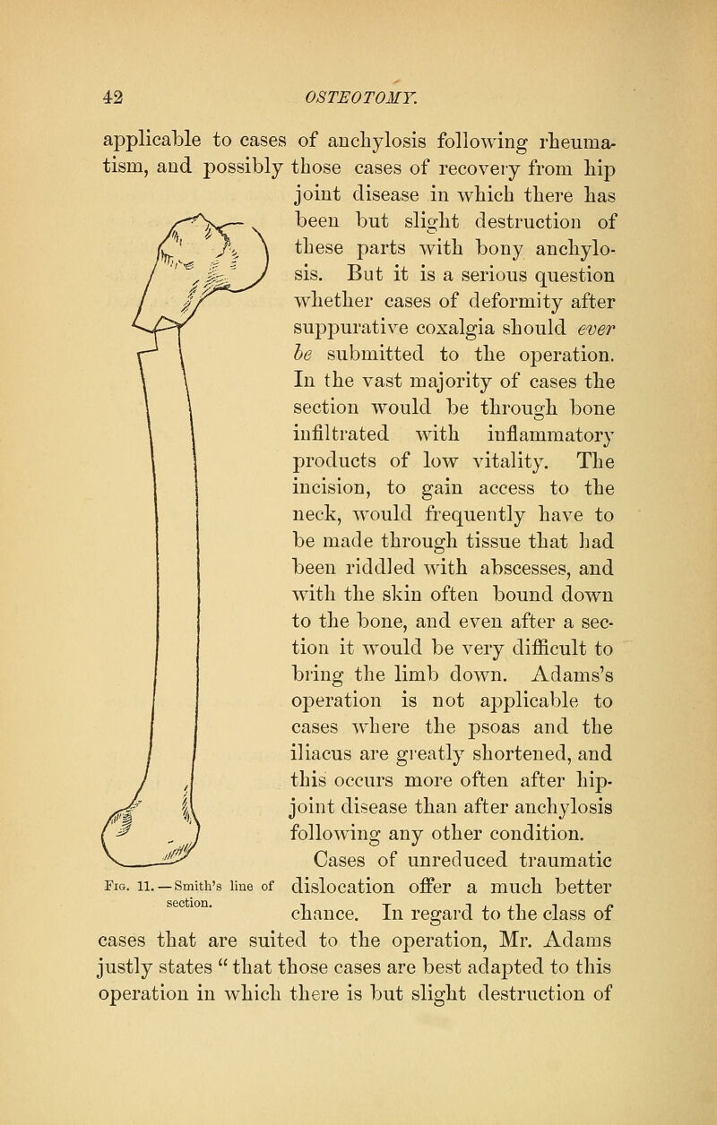 applicable to cases of anchylosis following rheuma- tism, and possibly those cases of recovery from hip joint disease in which there has been but slight destruction of these parts with bony anchylo- sis. But it is a serious question whether cases of deformity after suppurative coxalgia should ever be submitted to the operation. In the vast majority of cases the section would be through bone infiltrated with inflammatory products of low vitality. The incision, to gain access to the neck, would frequently have to be made through tissue that had been riddled with abscesses, and with the skin often bound down to the bone, and even after a sec- tion it would be very difficult to bring the limb down. Adams's operation is not applicable to cases where the psoas and the iliacus are greatly shortened, and this occurs more often after hip- joint disease than after anchylosis following any other condition. Cases of unreduced traumatic dislocation offer a much better chance. In regard to the class of cases that are suited to the operation, Mr. Adams justly states  that those cases are best adapted to this operation in which there is but slight destruction of Fig. 11. —Smith's line of section.