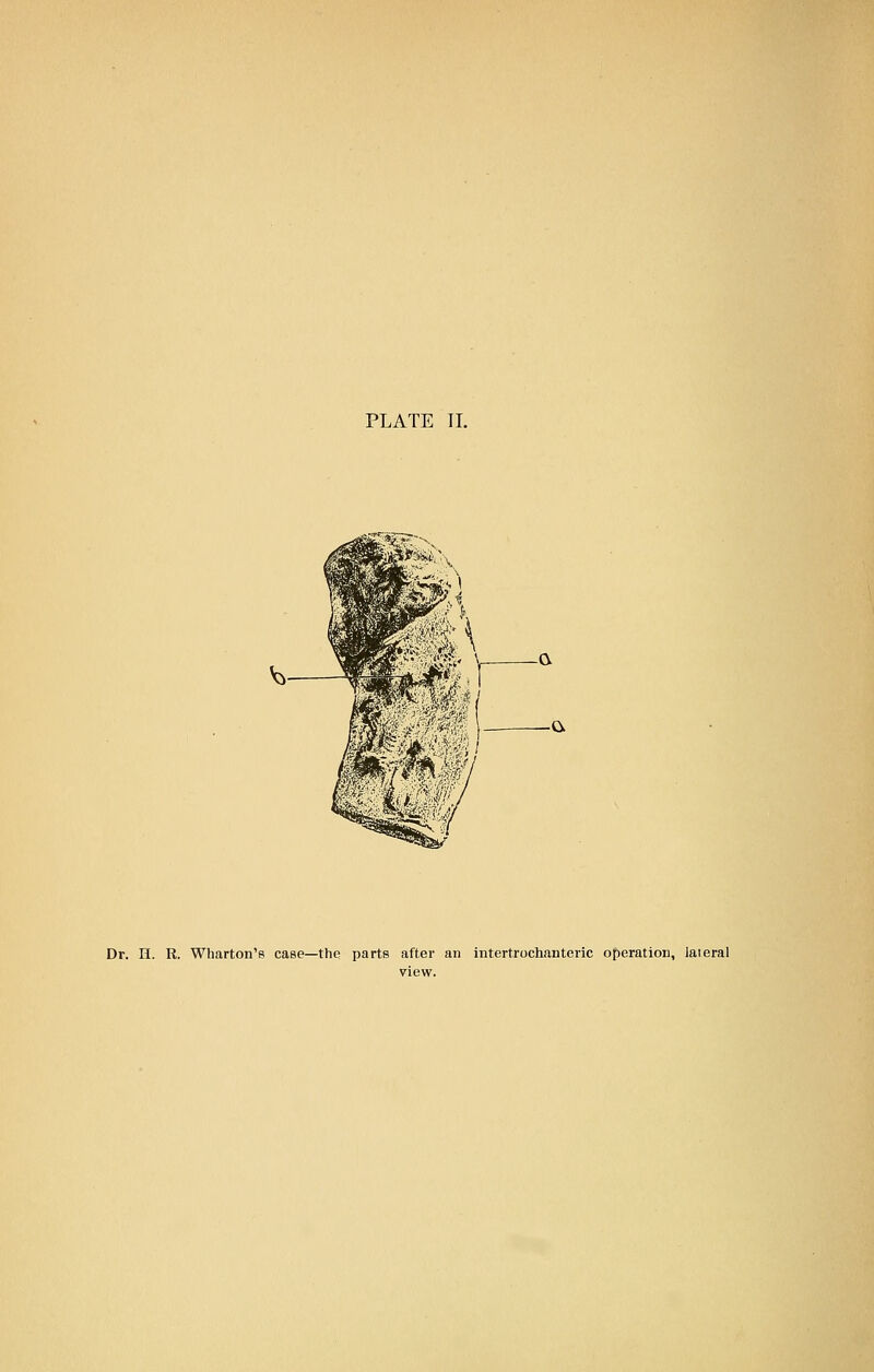 Dr. II. R. Wharton's case—the parts after an intertrochanteric operation, lateral view.