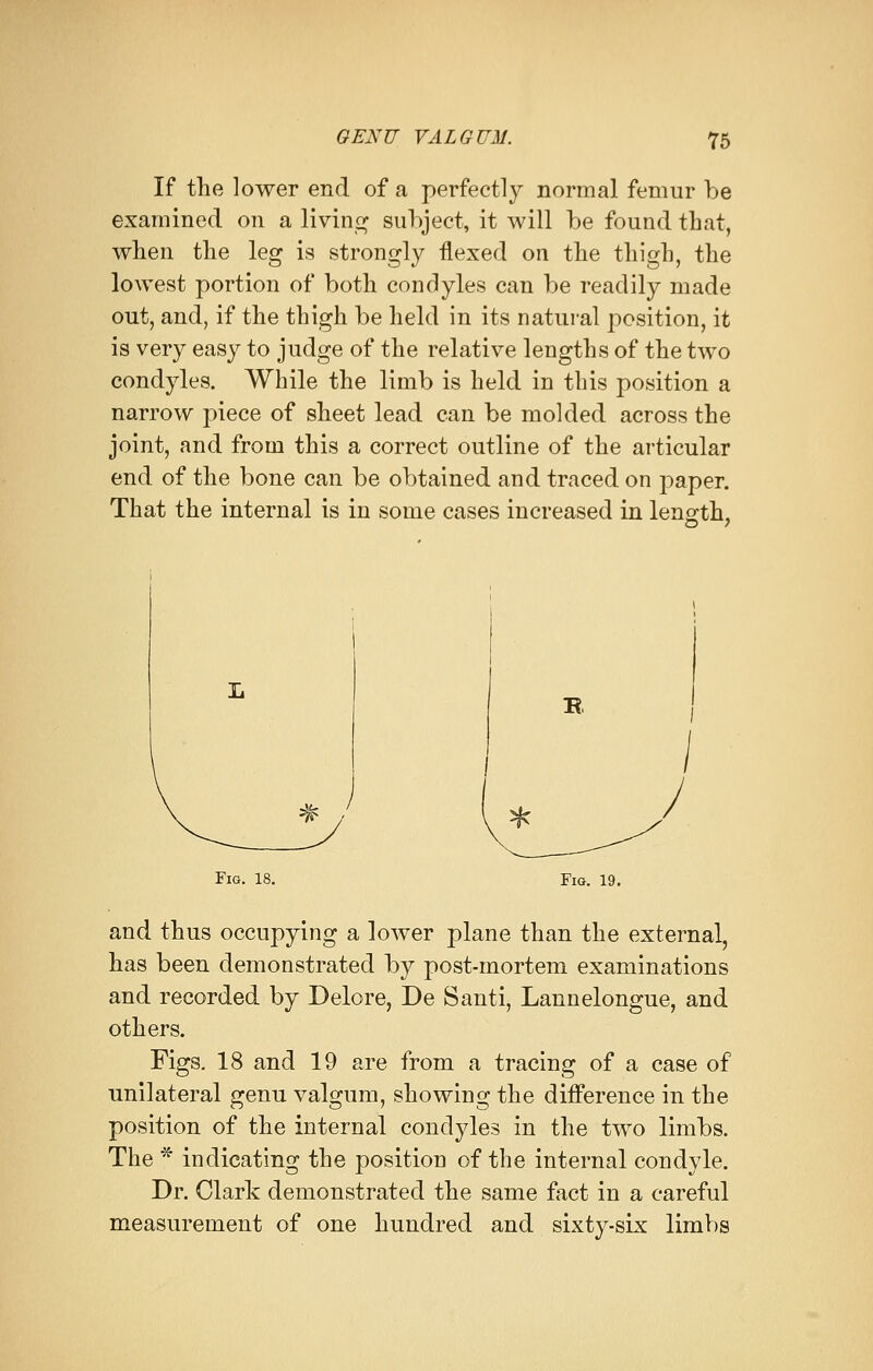 If the lower end of a perfectly normal femur be examined on a living subject, it will be found that, when the leg is strongly flexed on the thigh, the lowest portion of both condyles can be readily made out, and, if the thigh be held in its natural position, it is very easy to judge of the relative lengths of the two condyles. While the limb is held in this position a narrow piece of sheet lead can be molded across the joint, and from this a correct outline of the articular end of the bone can be obtained and traced on paper. That the internal is in some cases increased in length, O 1 '/i- Fig. 18. Fig. 19. and thus occupying a lower plane than the external, has been demonstrated by post-mortem examinations and recorded by Delore, De Santi, Lannelongue, and others. Figs. 18 and 19 are from a tracing of a case of unilateral genu valgum, showing the difference in the position of the internal condyles in the two limbs. The * indicating the position of the internal condyle. Dr. Clark demonstrated the same fact in a careful measurement of one hundred and sixty-six limbs