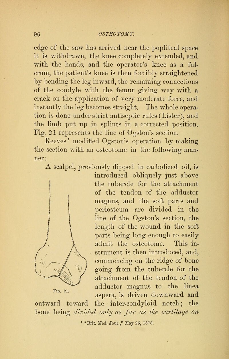 edge of the saw lias arrived near the popliteal space it is withdrawn, the knee completely extended, and with the hands, and the operator's knee as a ful- crum, the patient's knee is then forcibly straightened by bending the leg inward, the remaining connections of the condyle with the femur giving way with a crack on the application of very moderate force, and instantly the leg becomes straight. The whole opera- tion is done under strict antiseptic rules (Lister), and the limb put up in splints in a corrected position. Fig. 21 rejjresents the line of Ogston's section. Reeves1 modified Ogston's operation by making the section with an osteotome in the following man- ner: A scalpel, previously dipped in carbolized oil, is introduced obliquely just above the tubercle for the attachment of the tendon of the adductor magnus, and the soft parts and periosteum are divided in the line of the Ogston's section, the length of the wound in the soft parts being long enough to easily admit the osteotome. This in- strument is then introduced, and, commencing on the ridge of bone going from the tubercle for the attachment of the tendon of the adductor magnus to the linea aspera, is driven downward and outward toward the inter-condyloid notch; the bone being divided only as far as the cartilage on 1 Brit. Med. Jour., May 25, 18*78.