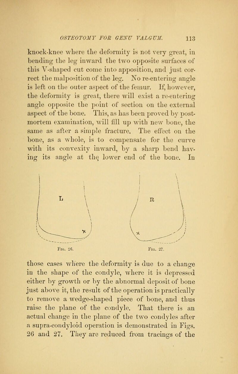 knock-knee where the deformity is not very great, in bending the leg inward the two opposite surfaces of this V-shaped cut come into apposition, and just cor- rect the malposition of the leg. ~No re-entering angle is left on the outer aspect of the femur. If, however, the deformity is great, there will exist a re-entering angle opposite the point of section on the external aspect of the bone. This, as has been proved by post- mortem examination, will till up with new bone, the same as after a simple fracture. The effect on the bone, as a whole, is to compensate for the curve with its convexity inward, by a sharp bend hav- ing its angle at the lower end of the bone. In Fig. 26. Fig. 27. those cases where the deformity is due to a change in the shape of the condyle, where it is depressed either by growth or by the abnormal deposit of bone just above it, the result of the operation is practically to remove a wedge-shaped piece of bone, and thus raise the plane of the condyle. That there is an actual change in the plane of the two condyles after a supra-condyloid operation is demonstrated in Figs. 26 and 27. They are reduced from tracings of the