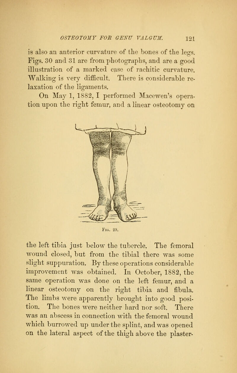 is also an anterior curvature of the bones of the legs. Figs. 30 and 31 are from photographs, and are a good illustration of a marked case of rachitic curvature. Walking is very difficult. There is considerable re- laxation of the ligaments. On May 1, 1882, I performed Macewen's opera- tion upon the right femur, and a linear osteotomy on Fig. 29. the left tibia just below the tubercle. The femoral wound closed, but from the tibial there was some slight suppuration. By these operations considerable improvement was obtained. In October, 1882, the same operation was done on the left femur, and a linear osteotomy on the right tibia and fibula. The limbs were apparently brought into good posi- tion. The bones were neither hard nor soft. There was an abscess in connection with the femoral wound which burrowed up under the splint, and was opened on the lateral aspect of the thigh above the plaster-