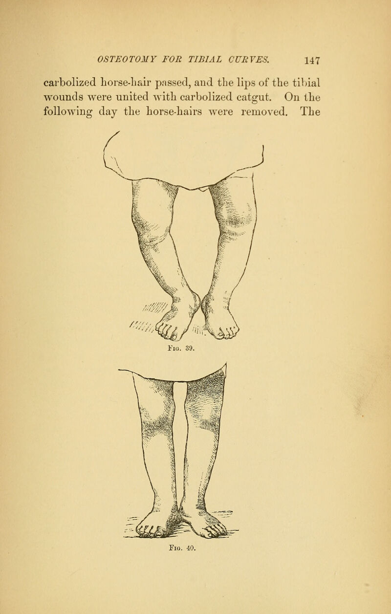 carbolized horse-Lair passed, and the lips of the tibial wounds were united with carbolized catgut. On the following day the horse-hairs were removed. The Fig. 39. Fig. 40.