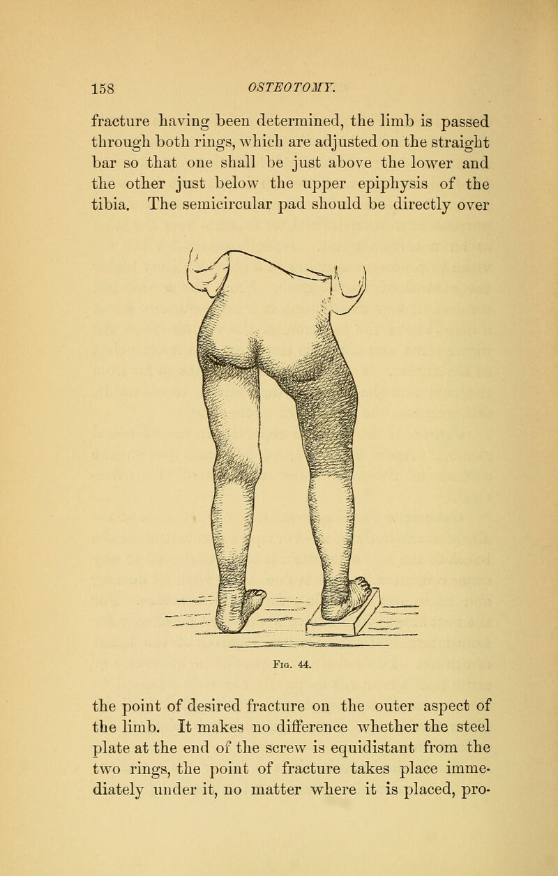 fracture having been determined, the limb is passed through both rings, which are adjusted on the straight bar so that one shall be just above the lower and the other just below the upper epiphysis of the tibia. The semicircular pad should be directly over Fig. 4A. the point of desired fracture on the outer aspect of the limb. It makes no difference whether the steel plate at the end of the screw is equidistant from the two rings, the point of fracture takes place imme- diately under it, no matter where it is placed, pro-