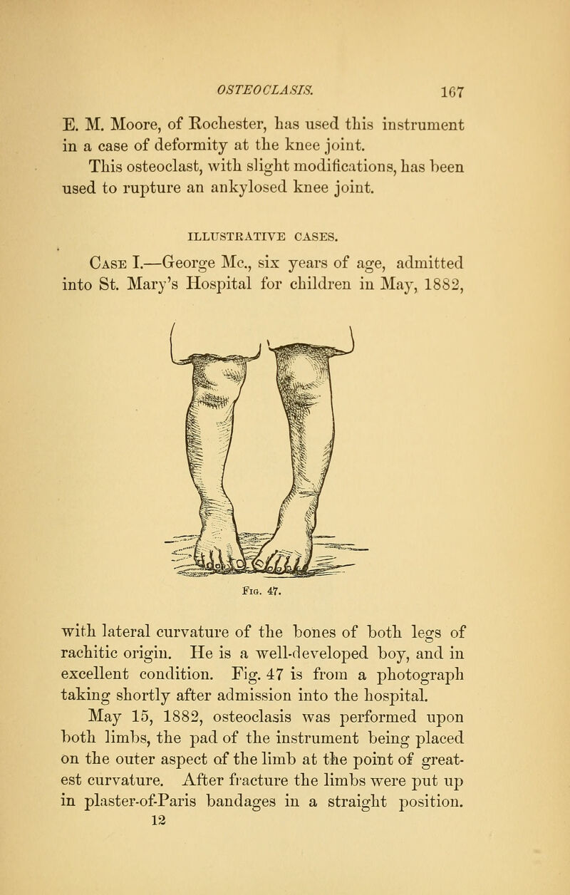 E. M. Moore, of Rochester, has used this instrument in a case of deformity at the knee joint. This osteoclast, with slight modifications, has been used to rupture an ankylosed knee joint. ILLUSTRATIVE CASES. Case I.—George Ma, six years of age, admitted into St. Mary's Hospital for children in May, 1882, Fig. 47. with lateral curvature of the bones of both legs of rachitic origin. He is a well-developed boy, and in excellent condition. Fig. 47 is from a photograph taking shortly after admission into the hospital. May 15, 1882, osteoclasis was performed upon both limbs, the pad of the instrument being placed on the outer aspect of the limb at the point of great- est curvature. After fracture the limbs were put up in plaster-of-Paris bandages in a straight position. 12