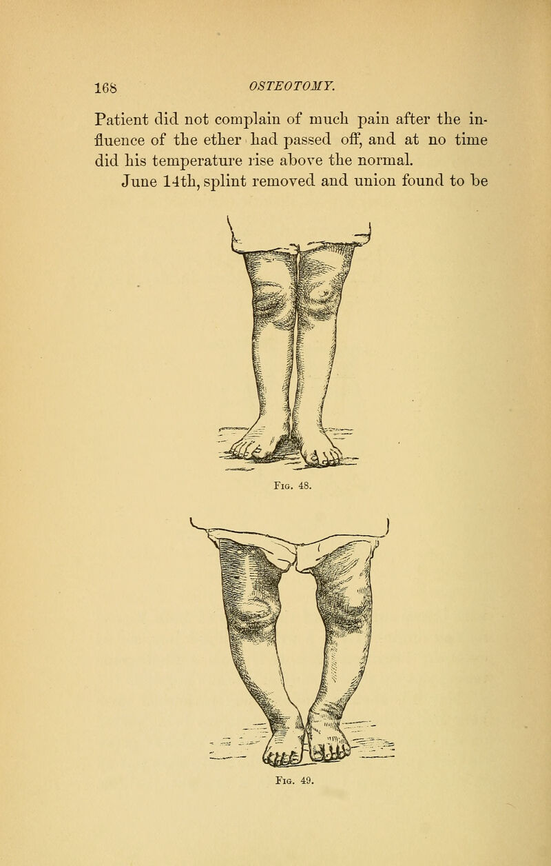 Patient did not complain of much pain after the in- fluence of the ether had passed off, and at no time did his temperature rise above the normal. June 14th, splint removed and union found to be Fig. 48. Fig. 49.