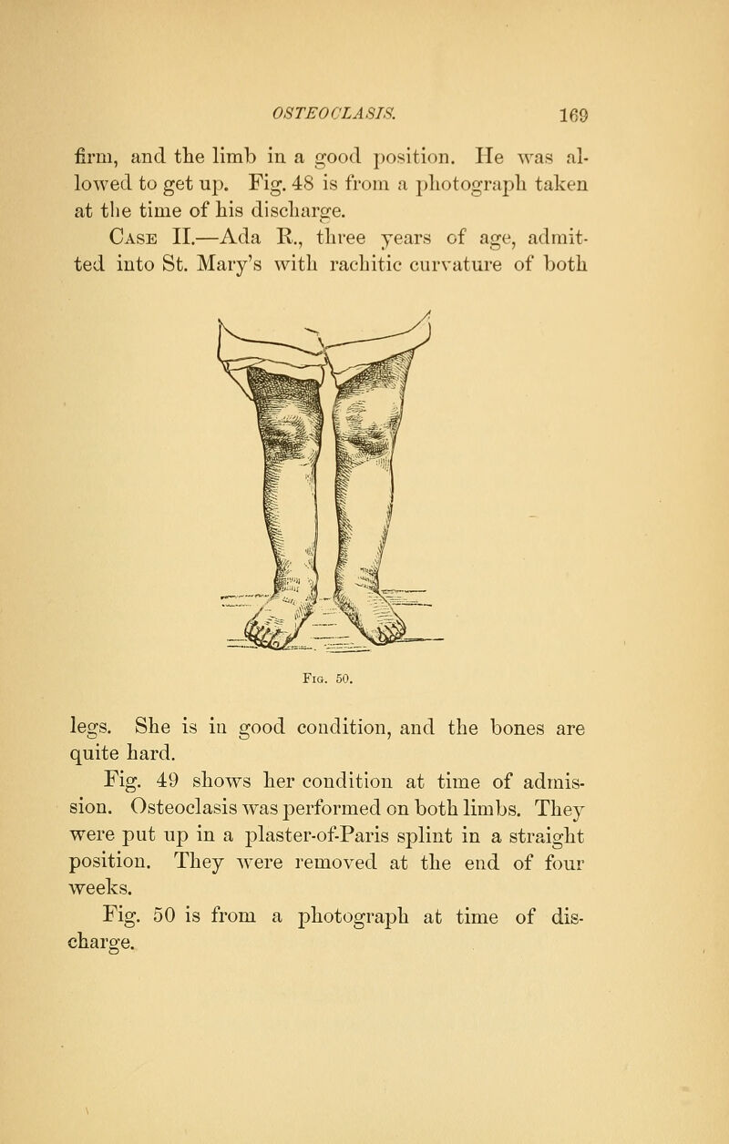 firm, and the limb in a good position. He was al- lowed to get up. Fig. 48 is from a photograph taken at the time of his discharge. Case II.—Ada R., three years of age, admit- ted into St. Mary's with rachitic curvature of both Fig. 50. legs. She is in good condition, and the bones are quite hard. Fig. 49 shows her condition at time of admis- sion. Osteoclasis was performed on both limbs. They were put up in a plaster-of-Paris splint in a straight position. They were removed at the end of four weeks. Fig. 50 is from a photograph at time of dis- charge.