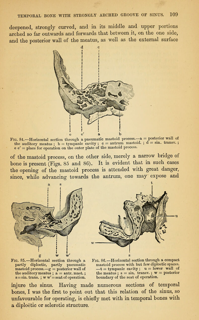 deepened, strongly curved, and in its middle and upper portions arched so far outwards and forwards that between it, on the one side, and the posterior wall of the meatus, as well as the external surface Fig. 84.—Horizontal section through a pneumatic mastoid process.—a = posterior wall of the auditory meatus ; b = tympanic cavity ; c = antrum mastoid. ; d = sin. transv. ; e e' = place for operation on the outer plate of the mastoid process. of the mastoid process, on the other side, merely a narrow bridge of bone is present (Figs. 85 and 86). It is evident that in such cases the opening of the mastoid process is attended with great danger, since, while advancing towards the antrum, one may expose and g w Fig. 85.—Horizontal section through a partly diploetic, partly pneumatic mastoid process.—g = posterior wall of the auditory meatus ; a = antr. mast.; s = sin. trans. ; w w' = seat of operation. Fig. 86.—Horizontal section through a compact mastoid process with but few diploetic spaces. —t = tympanic cavity ; u = lower wall of the meatus ; s = sin. transv. ; w — posterior boundary of the seat of operation. injure the sinus. Having made numerous sections of temporal bones, I was the first to point out that this relation of the sinus, so unfavourable for operating, is chiefly met with in temporal bones with a diploetic or sclerotic structure.