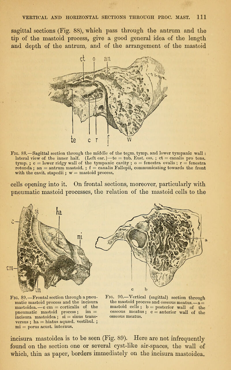 sagittal sections (Fig. 88), which pass through the antrum and the tip of the mastoid process, give a good general idea of the length and depth of the antrum., and of the arrangement of the mastoid Fig. 88.—Sagittal section through the middle of the tegm. tymp. and lower tympanic wall : lateral view of the inner half. (Left ear.)—te — tub. Eust. oss. ; ct = canalis pro tens, tymp. ; c = lower ridgy wall of the tympanic cavity ; o = fenestra ovalis ; r = fenestra rotunda; an = antrum mastoid. ; f = canalis Eallopii, communicating towards the front with the cavit. stapedii; w — mastoid process. cells opening into it. On frontal sections, moreover, particularly with pneumatic mastoid processes, the relation of the mastoid cells to the Fig. 89.—Frontal section through a pneu- matic mastoid process and the incisura mastoidea. — c cm = corticalis of the pneumatic mastoid process; im = incisura mastoidea ; si = sinus trans- versus ; ha = hiatus aqused. vestibul. ; mi = porus acust. internus. Fig. 90.—Vertical (sagittal) section through the mastoid process and osseous meatus.—a = mastoid cells ; b = posterior wall of the osseous meatus; c = anterior wall of the osseous meatus. incisura mastoidea is to be seen (Fig. 89). Here are not infrequently- found on the section one or several cyst-like air-spaces, the wall of which, thin as paper, borders immediately on the incisura mastoidea.